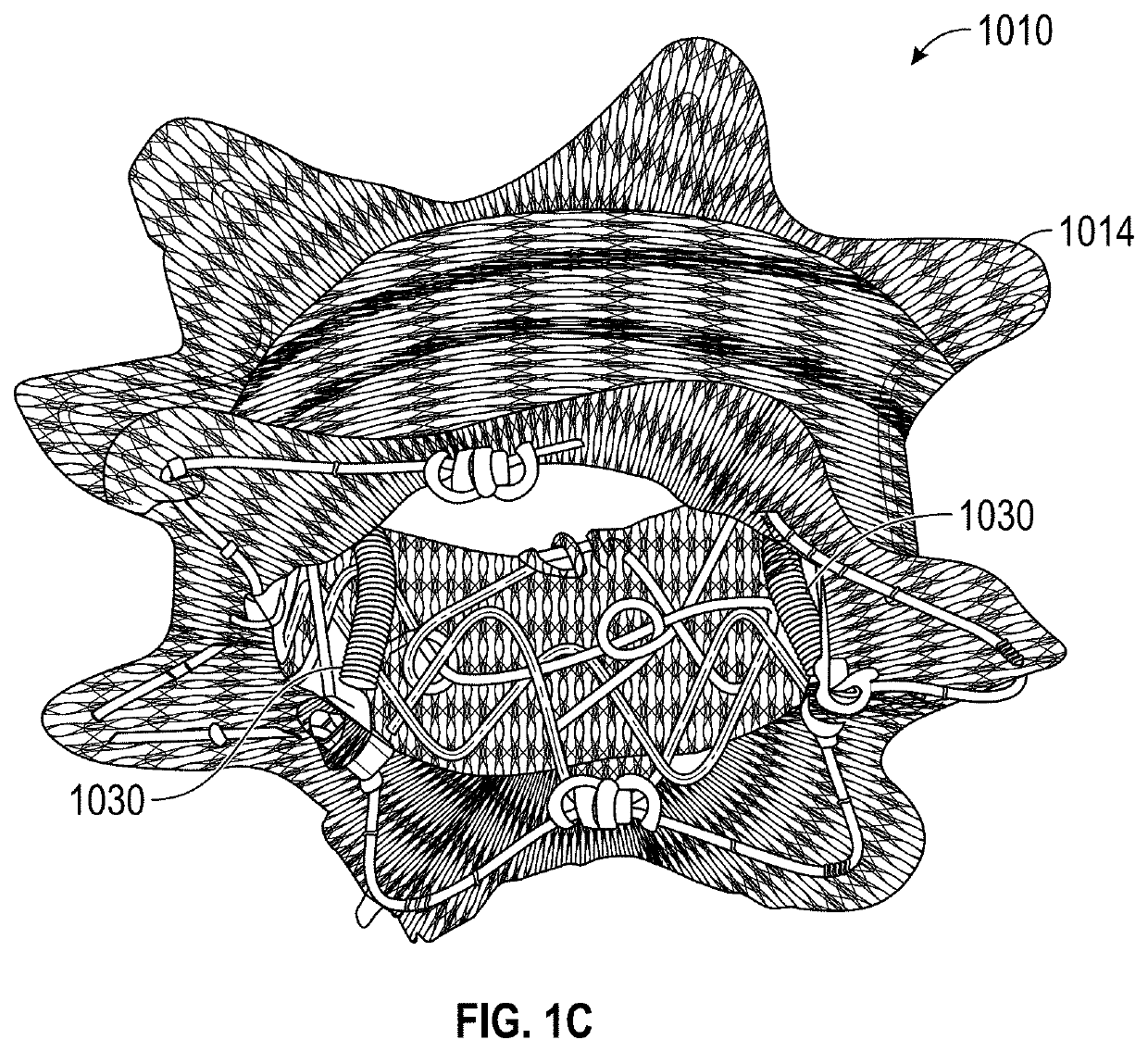 Percutaneous Potts Shunt Devices and Related Methods