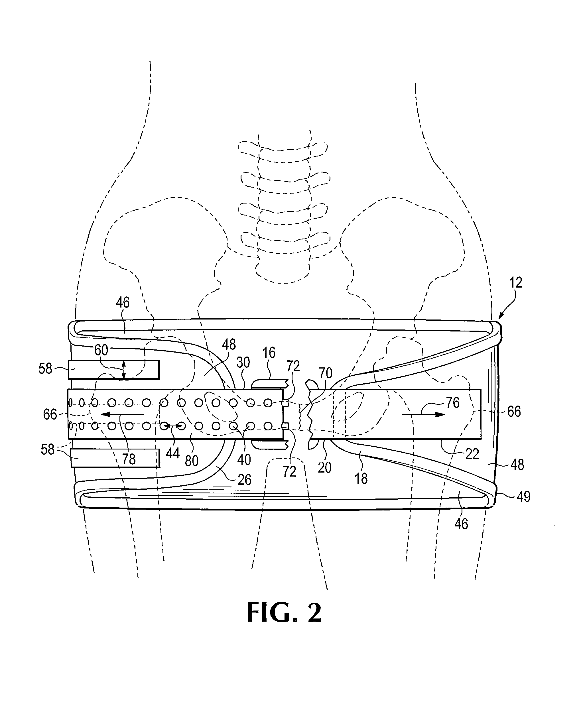 Device for control of hemorrhage including stabilized point pressure device