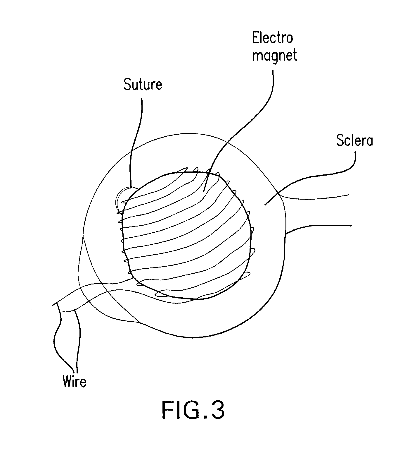 Method and composition for hyperthermally treating cells