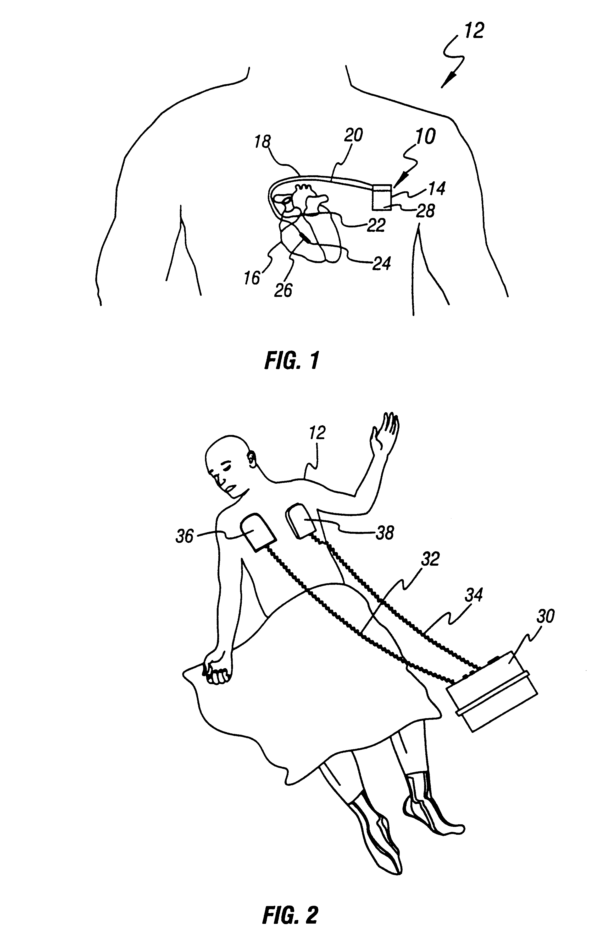 Method and apparatus for treatment of cardiac electromechanical dissociation