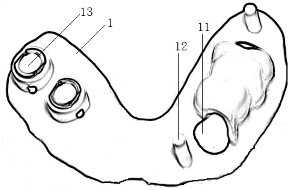 Combined guide plate for removable denture abutment tooth preparation and implant implantation and manufacturing method thereof