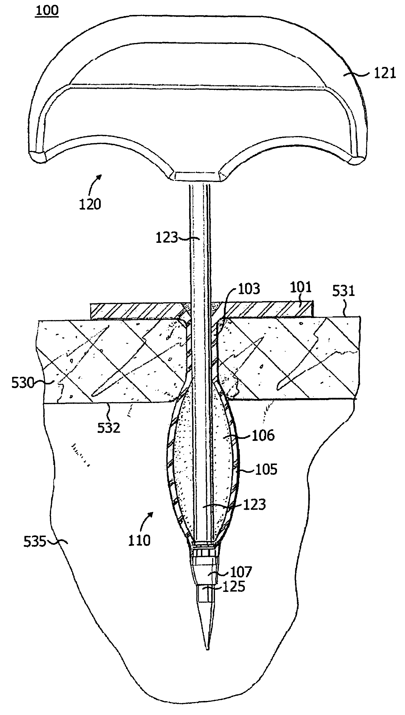 Elastically deformable surgical access device