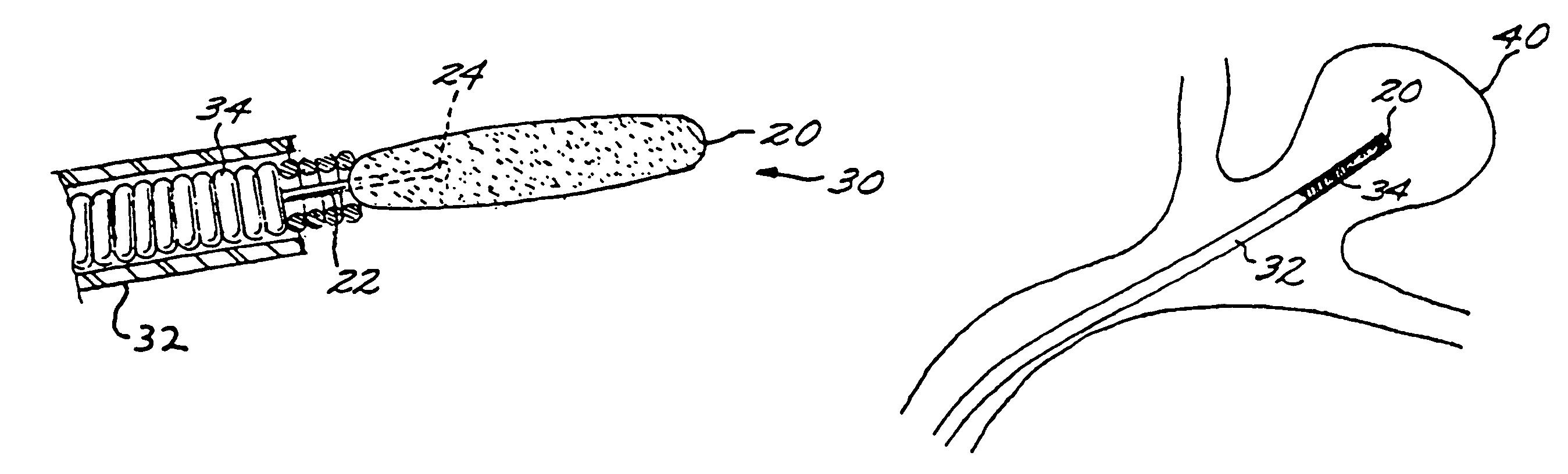 Vascular embolization with an expansible implant