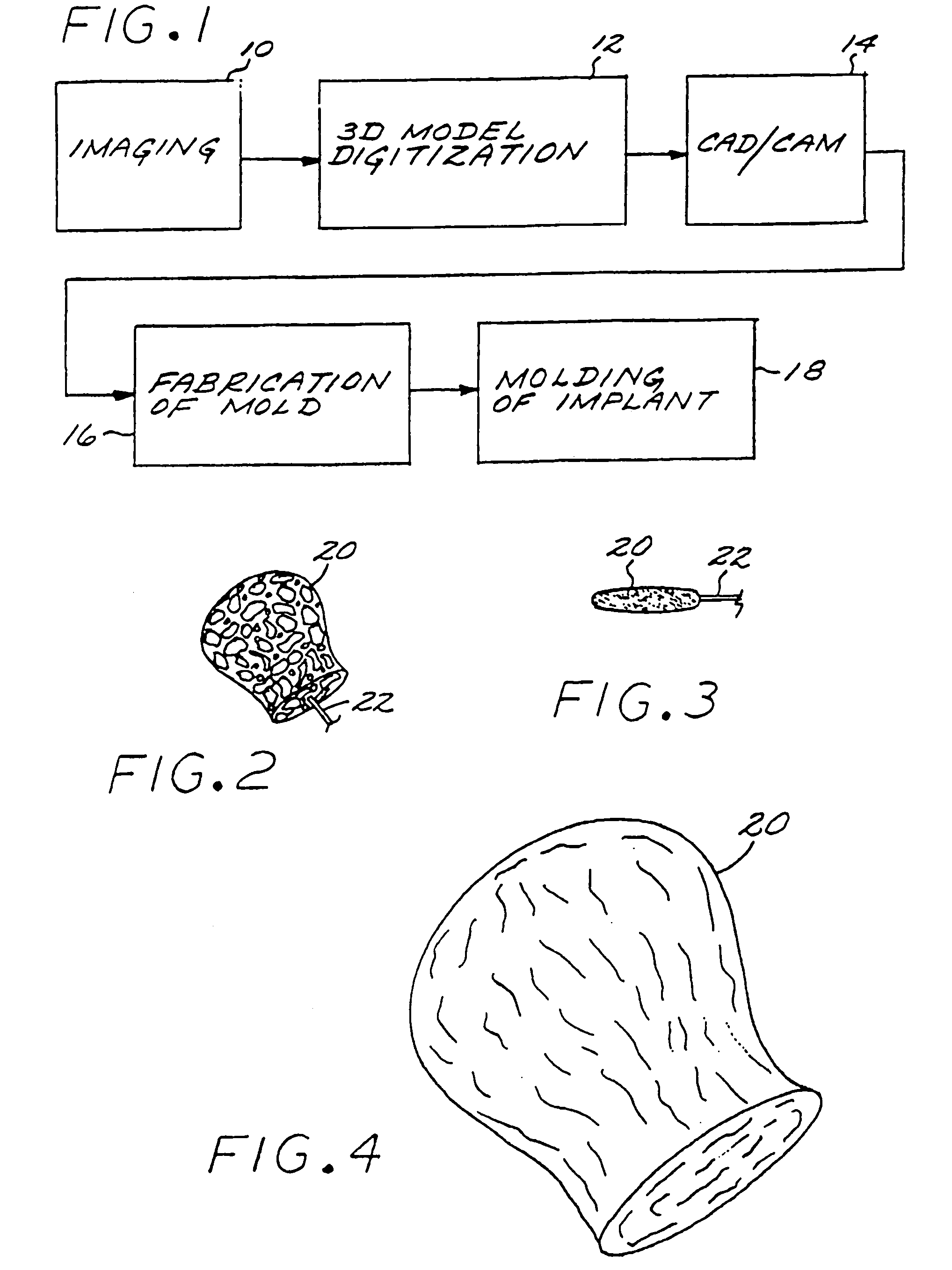 Vascular embolization with an expansible implant