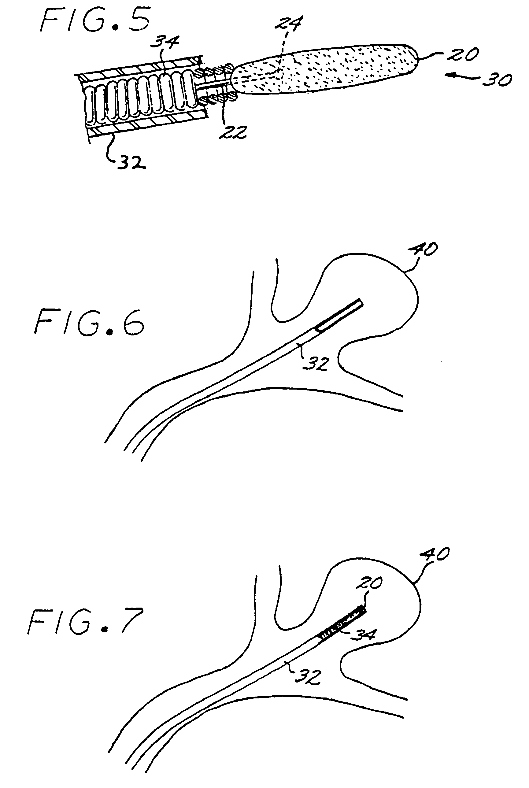 Vascular embolization with an expansible implant