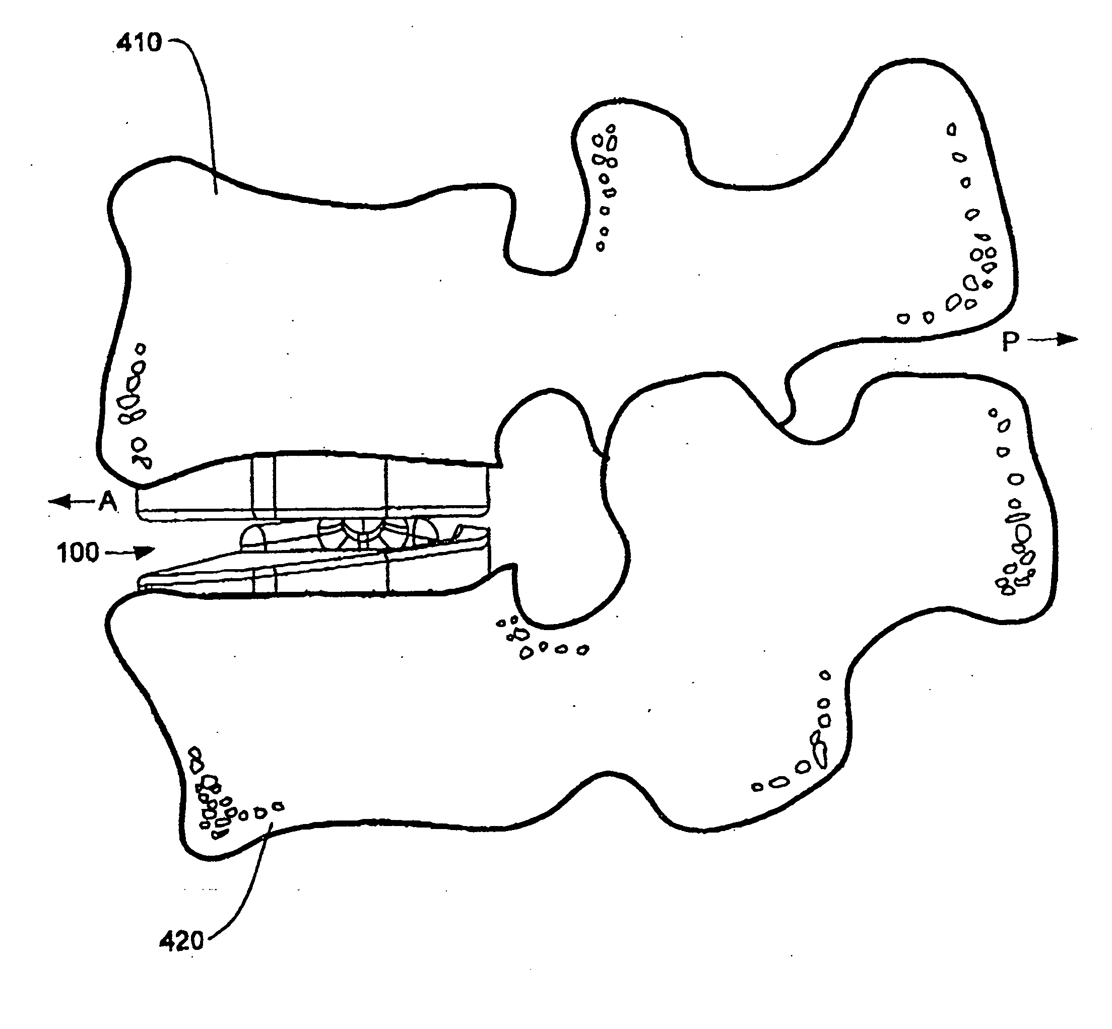 Artificial vertebral disk replacement implant with crossbar spacer and method