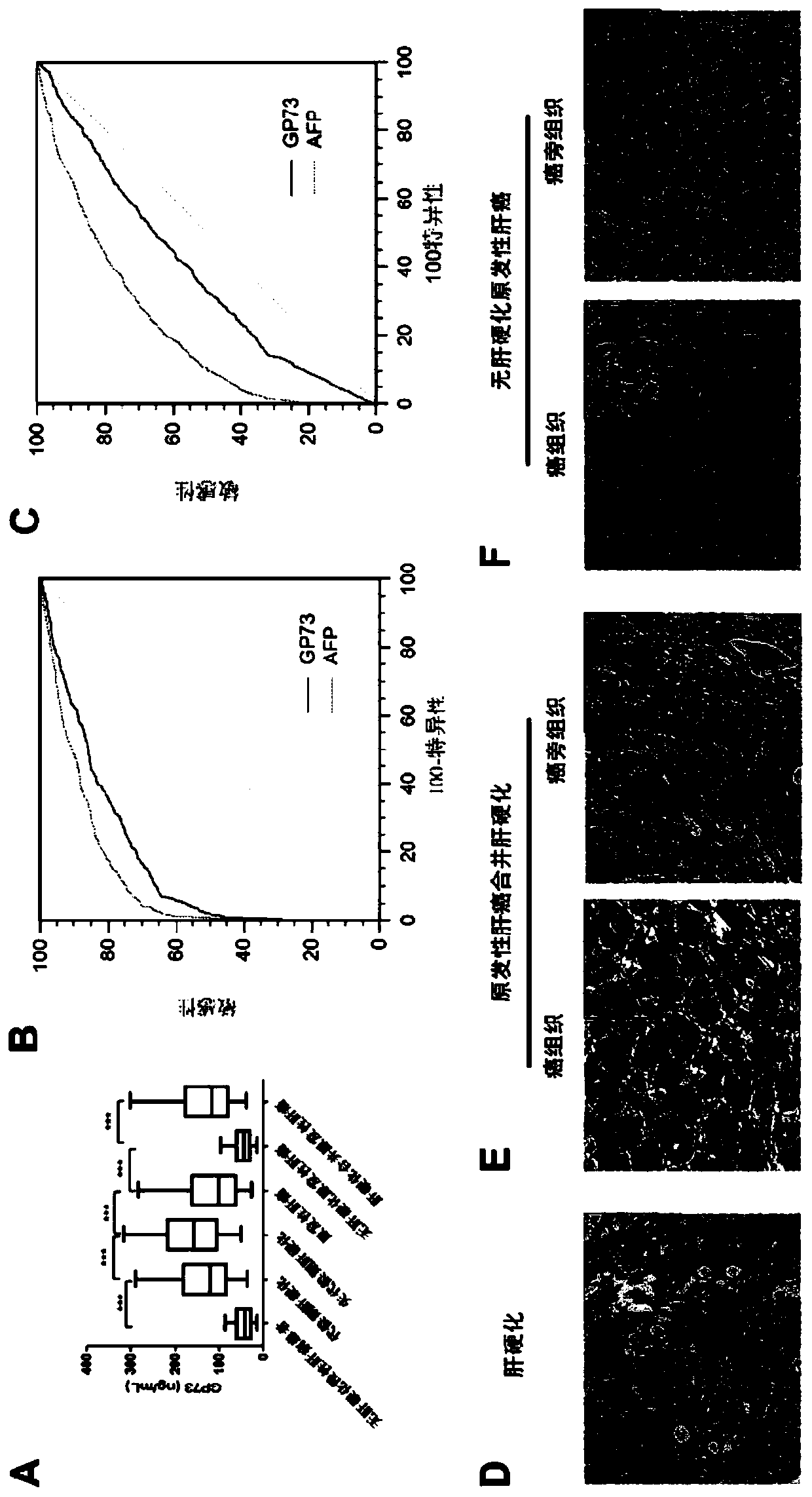 Novel marker of liver cirrhosis or liver fibrosis