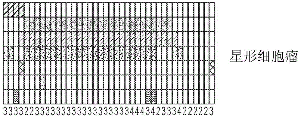 Tert promoter mutations in gliomas and subset of tumors