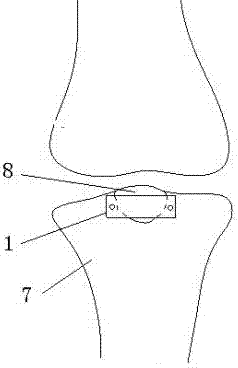 Absorbable fixing loop for treating back cross ligament avulsion fracture