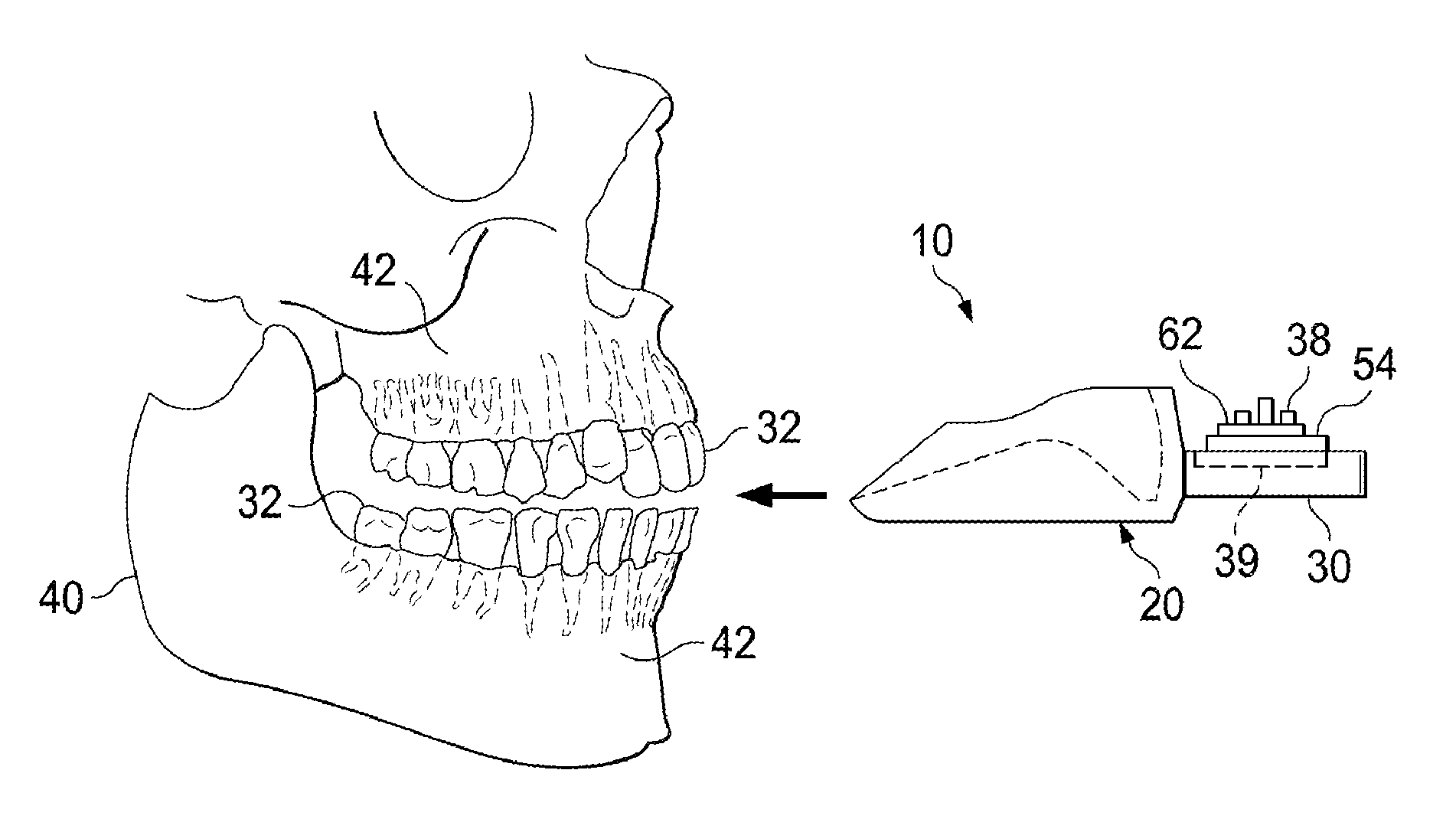 Vibrating orthodontic remodelling device