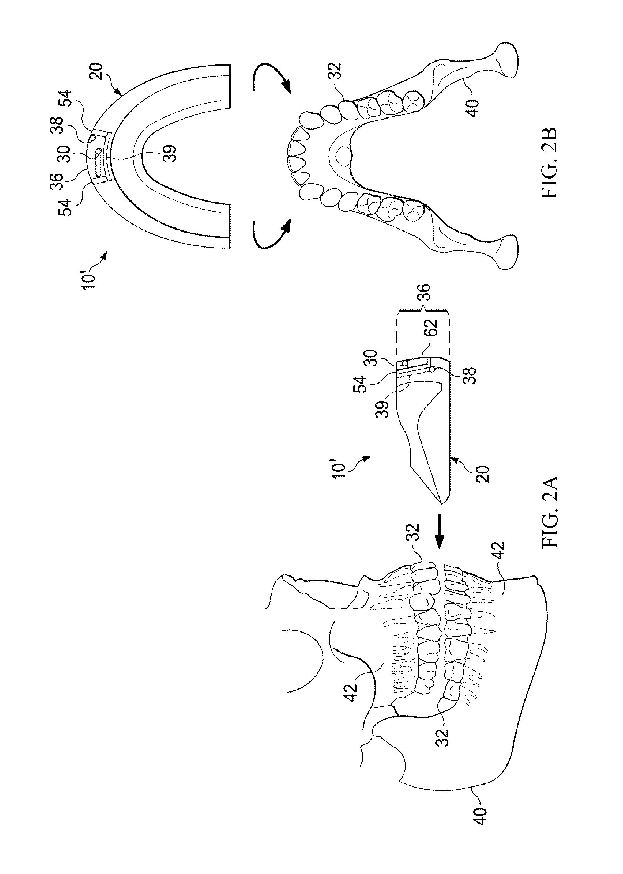 Vibrating orthodontic remodelling device