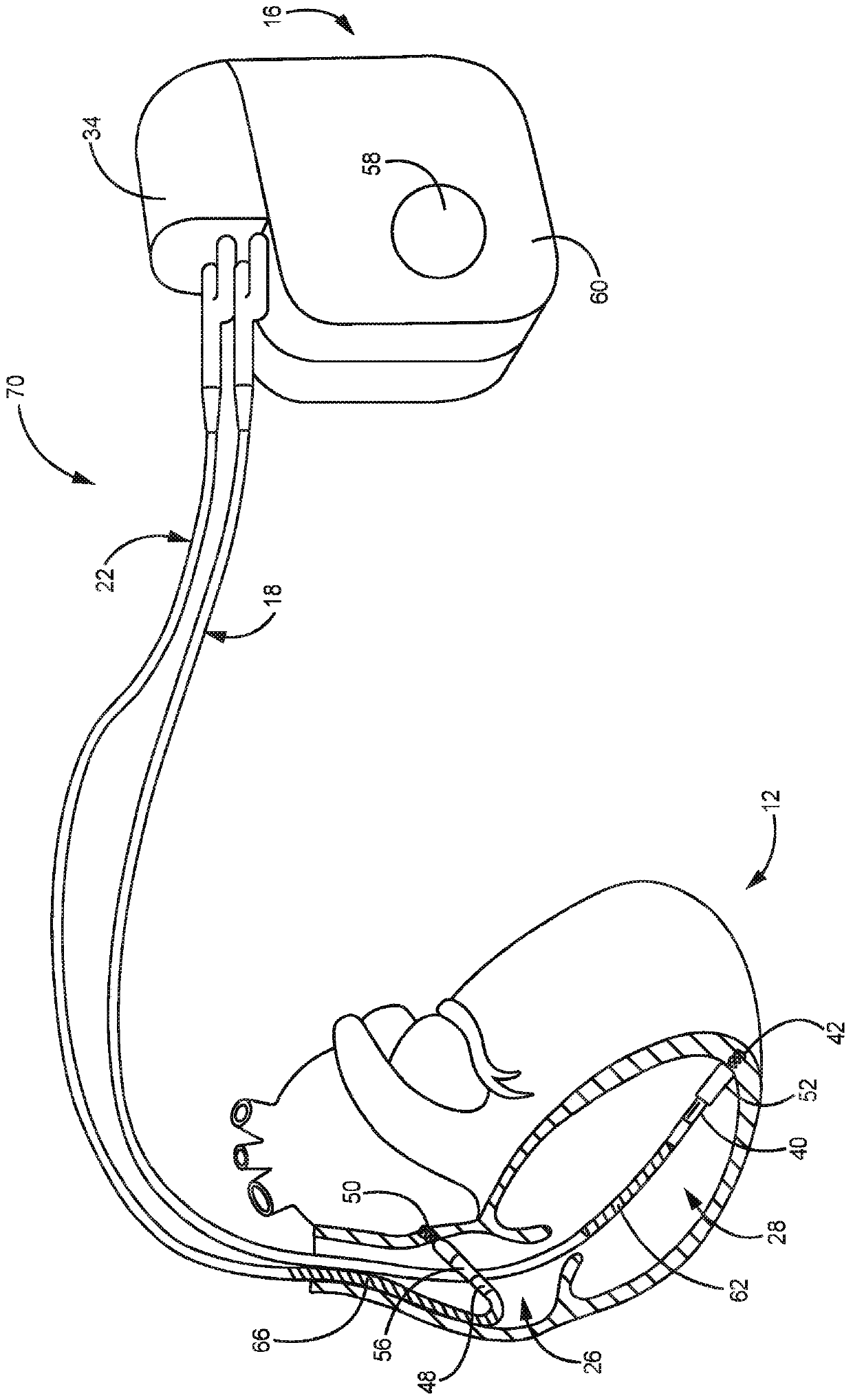 Pacemaker mediated tachycardia detection and intervention