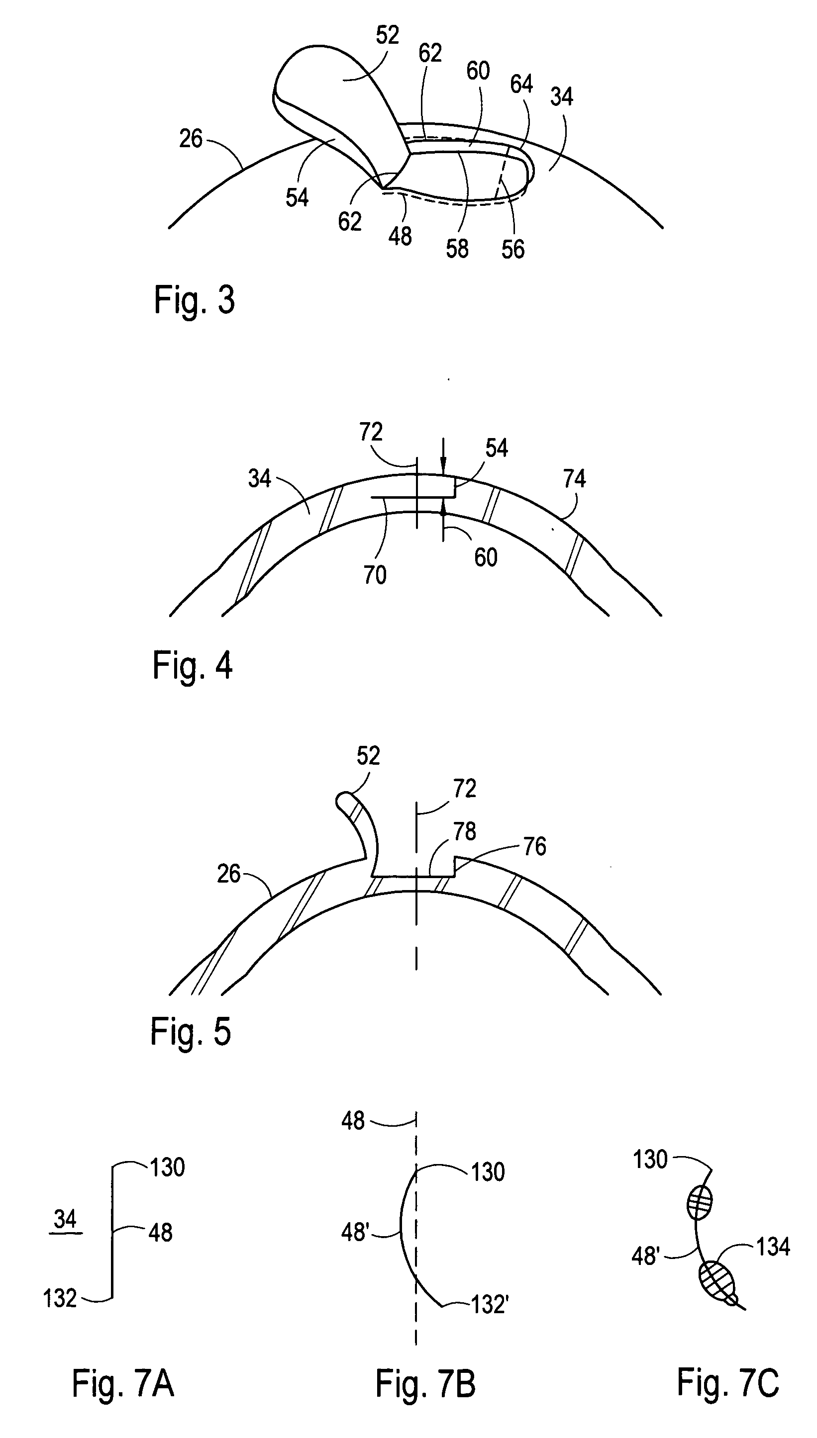 Customized corneal flap