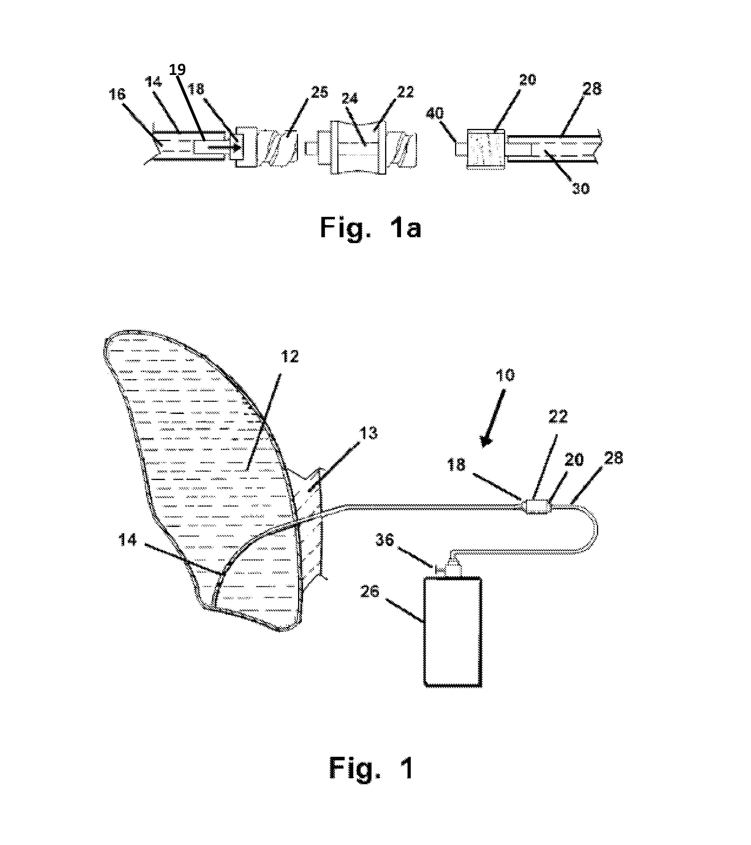 Method and apparatus for treatment of pleural effusion