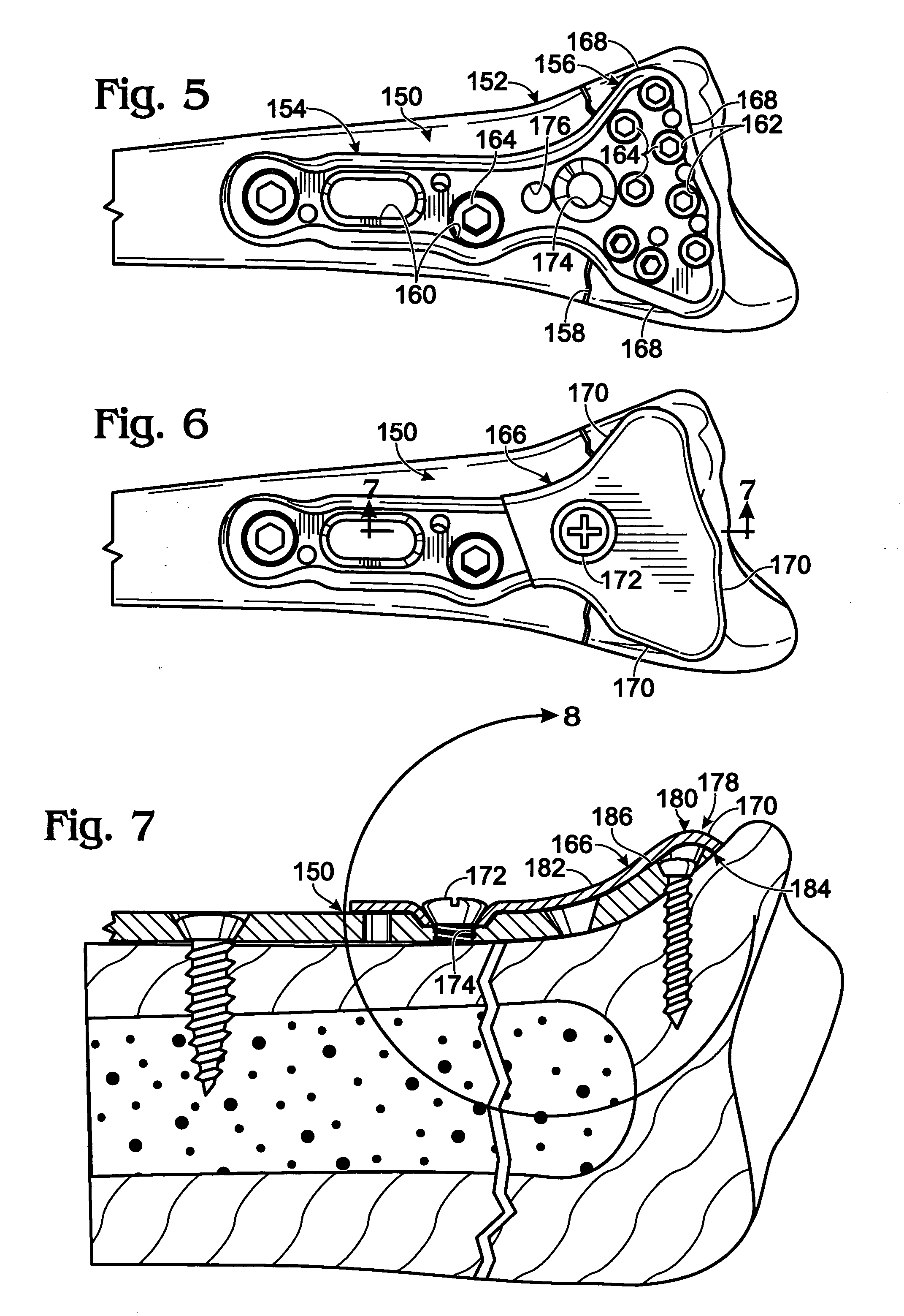 Bone plate with cover