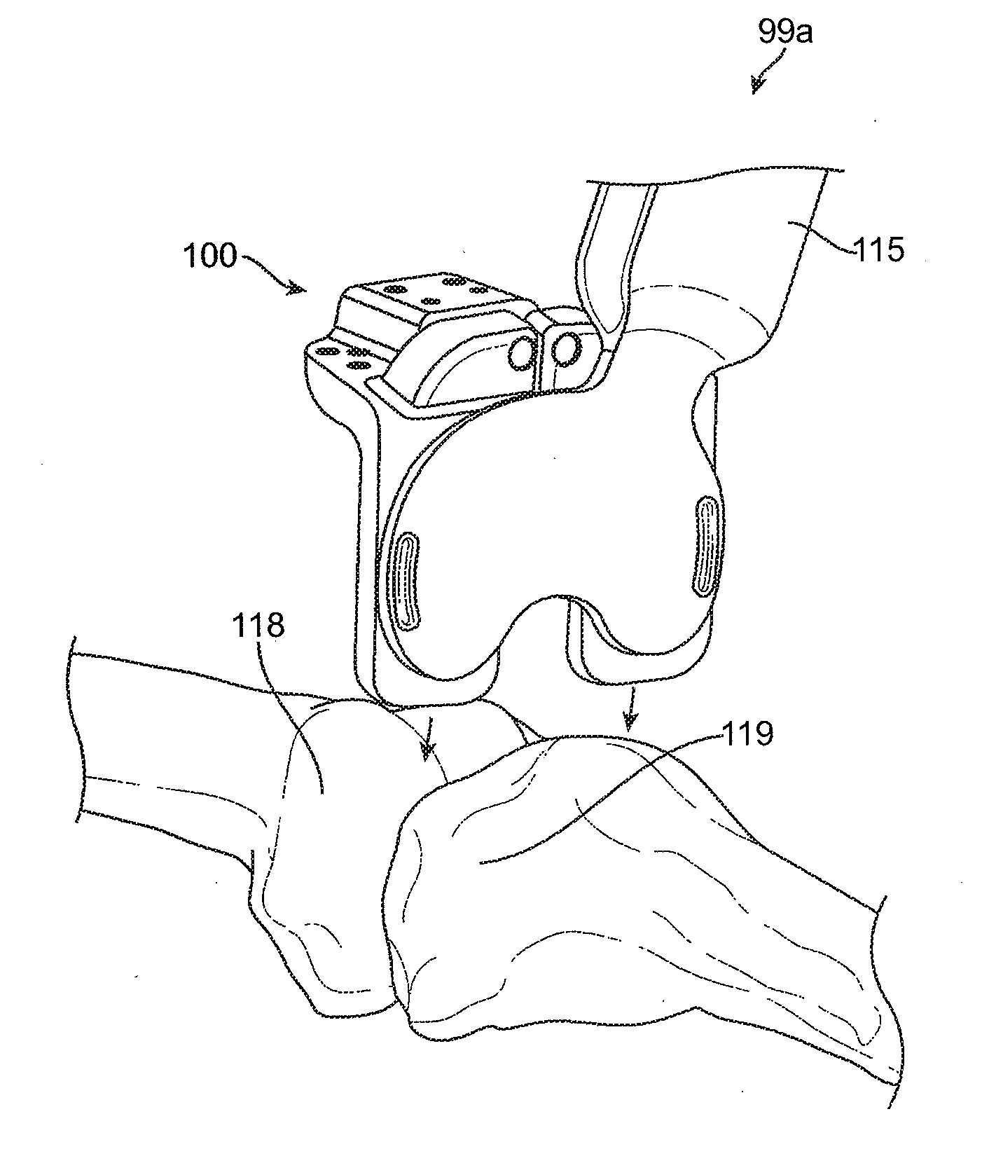 System for positioning a cutting guide in knee surgery