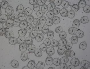 Application of dehydrocamelinarum derivatives as preparation of medicaments for the treatment of cystic hydatid disease