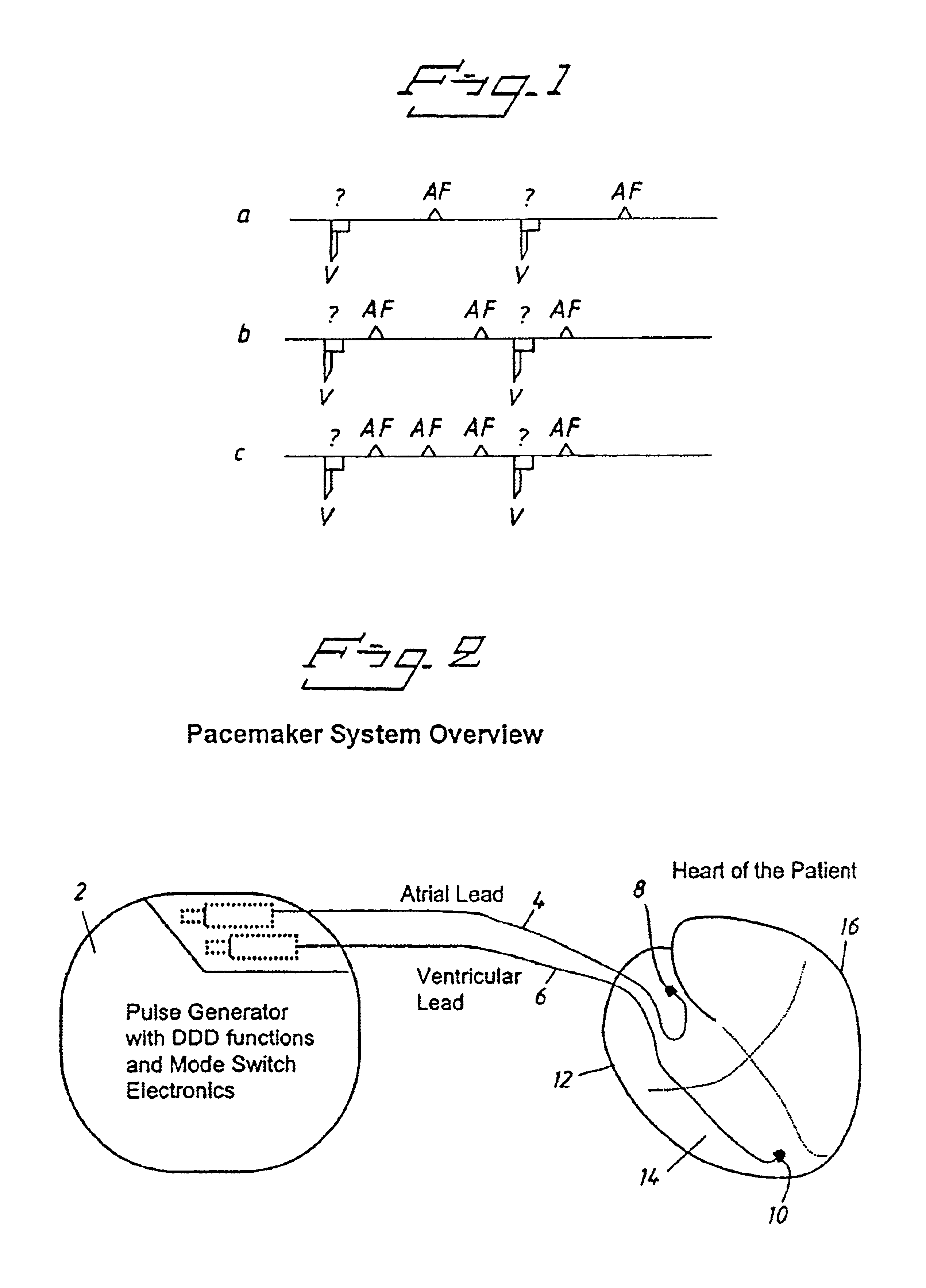 Pacemaker using measured intervals for mode switching