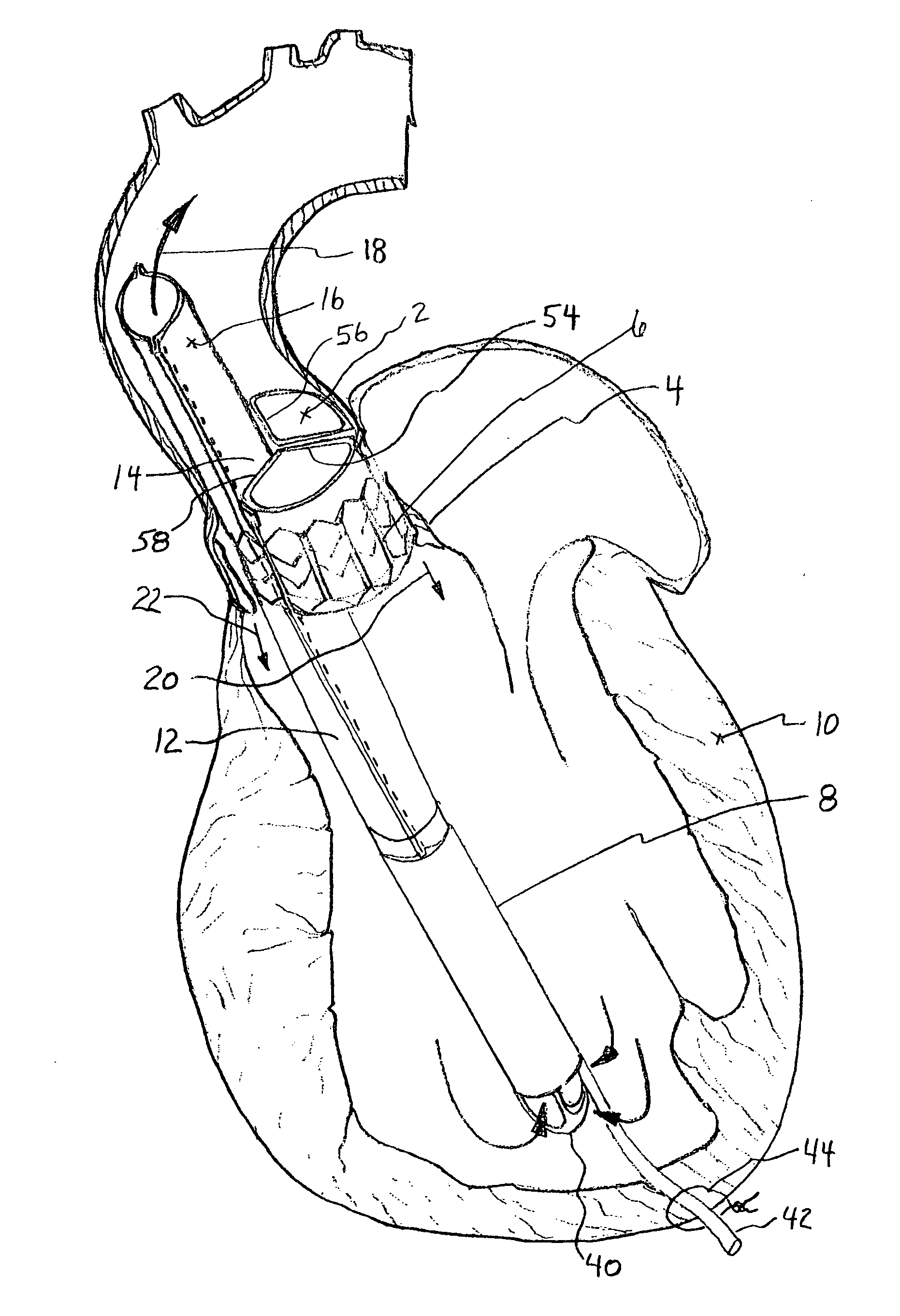 Intraventricular blood pumps anchored by expandable mounting devices