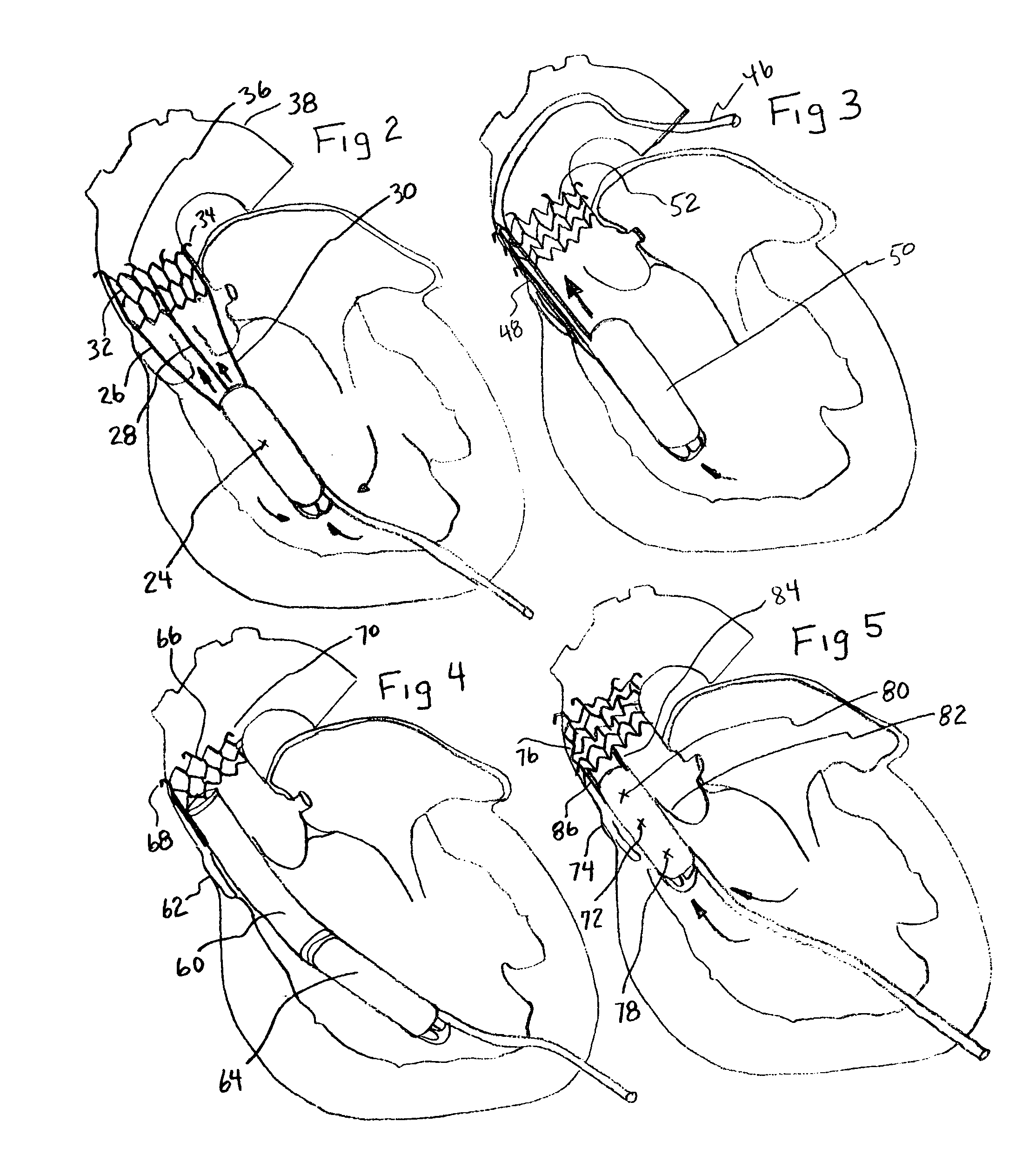 Intraventricular blood pumps anchored by expandable mounting devices