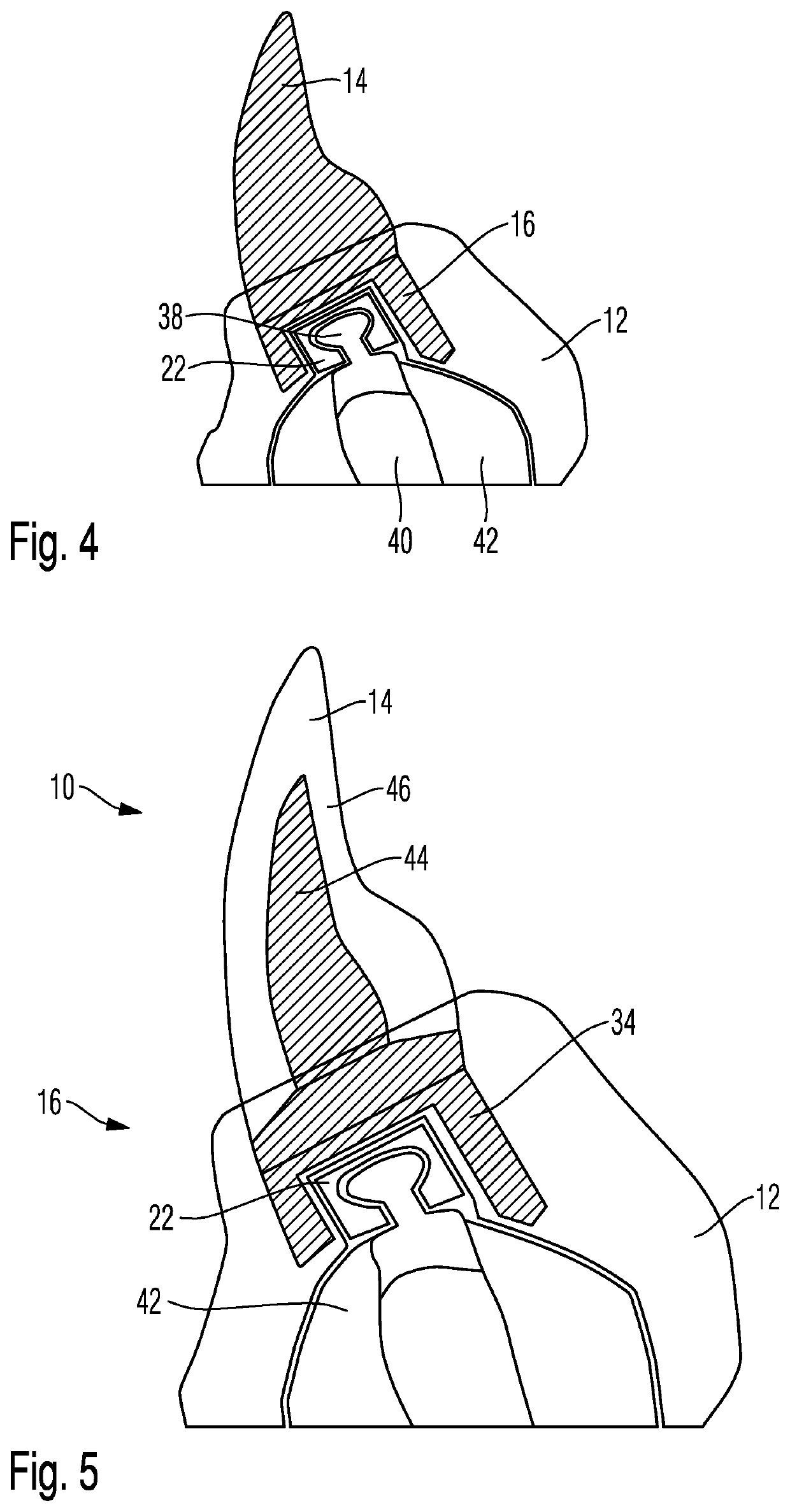 Dental Prosthesis