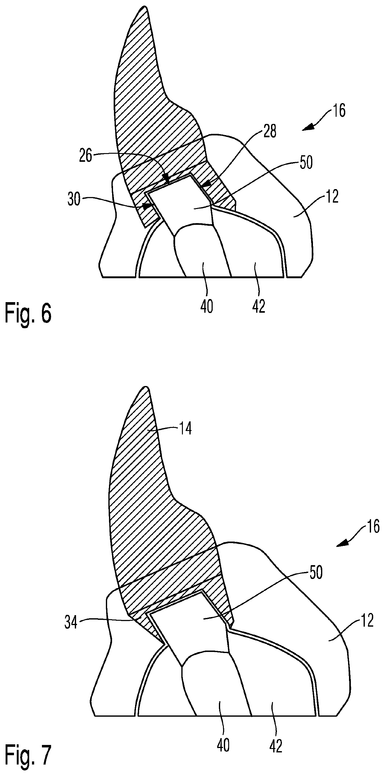 Dental Prosthesis