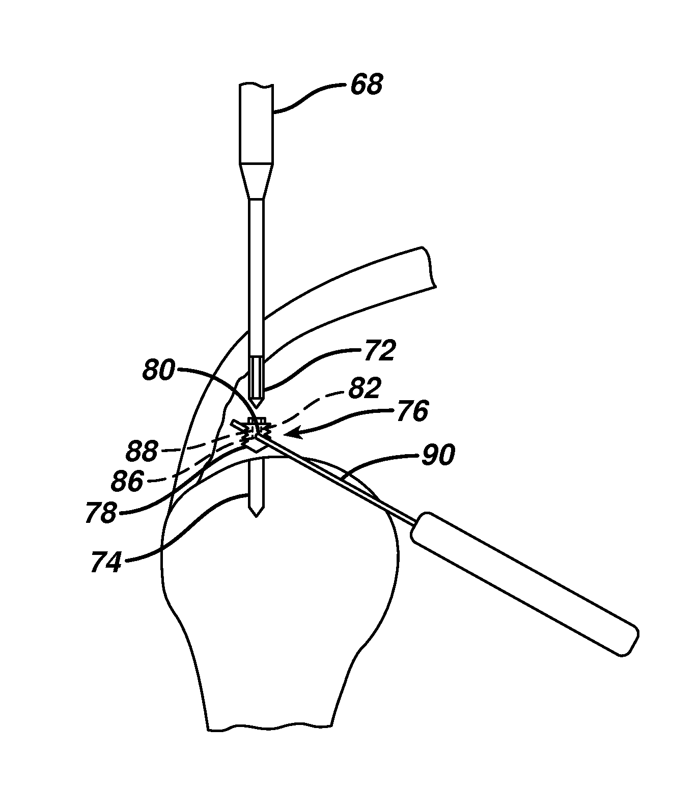 Partial thickness rotator cuff repair system and method