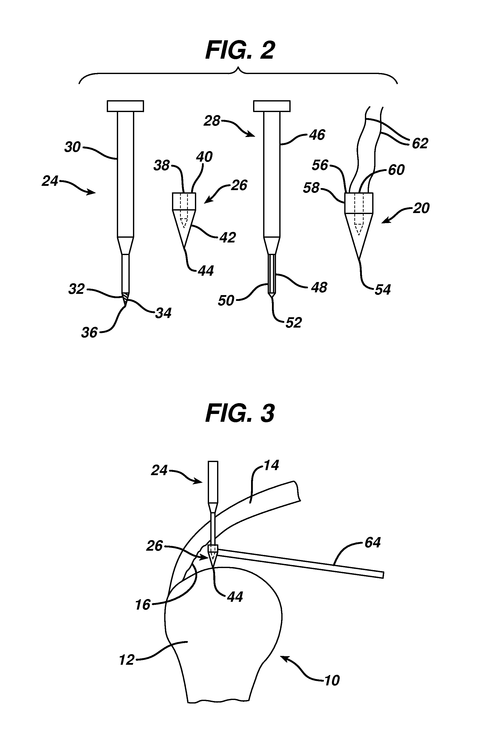 Partial thickness rotator cuff repair system and method