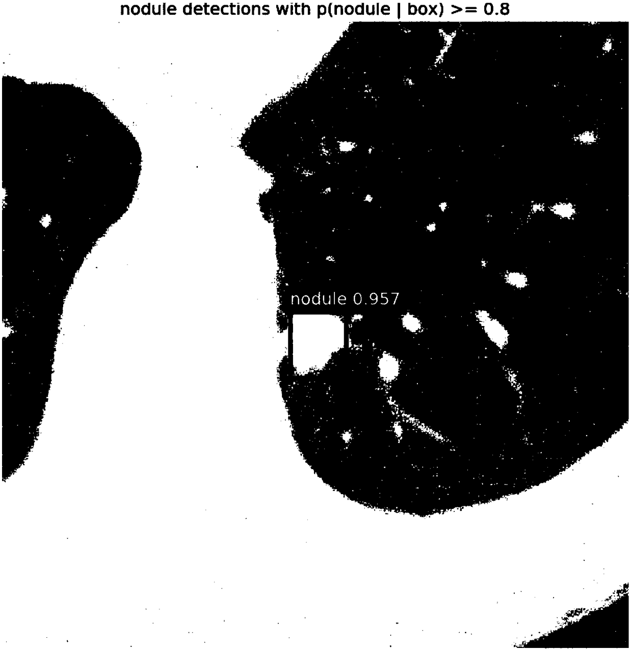 Medical image lung nodule detection method based on anti-network