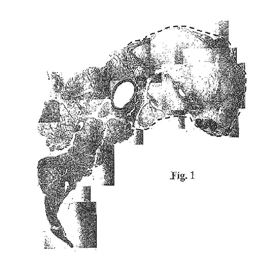 Method for improving treatment selectivity and efficacy using intravascular photodynamic therapy