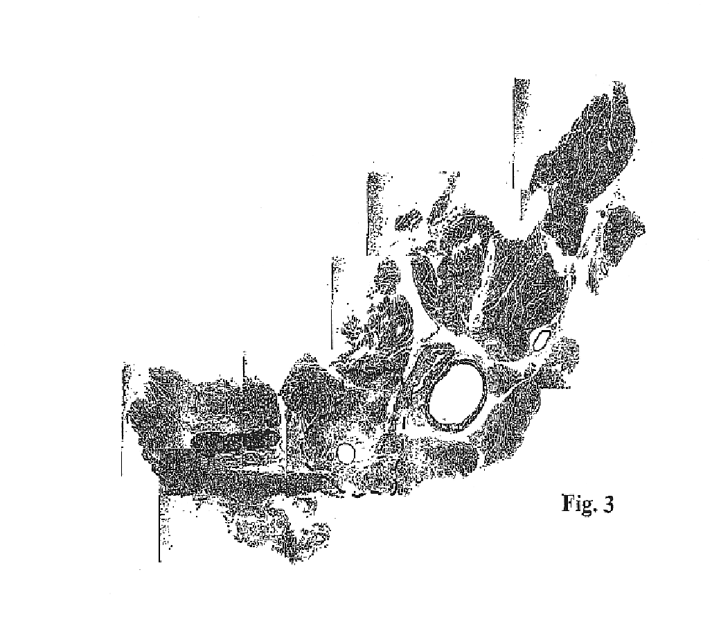 Method for improving treatment selectivity and efficacy using intravascular photodynamic therapy