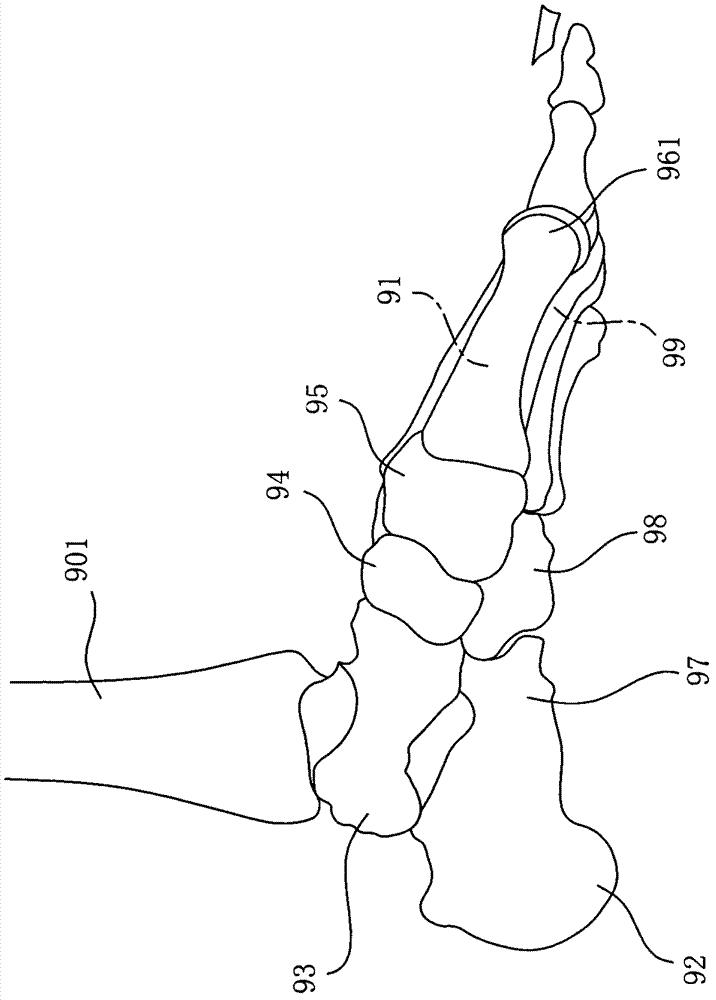 Arch correction pad capable of finely adjusting correction area and correction method of arch correction pad