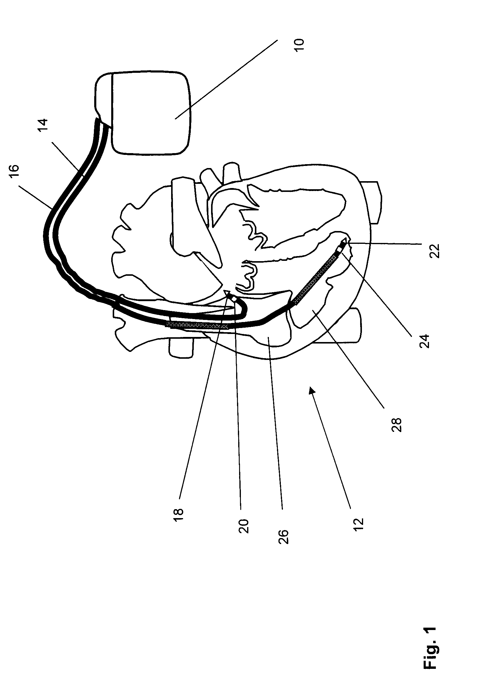 Implantable Medical Device