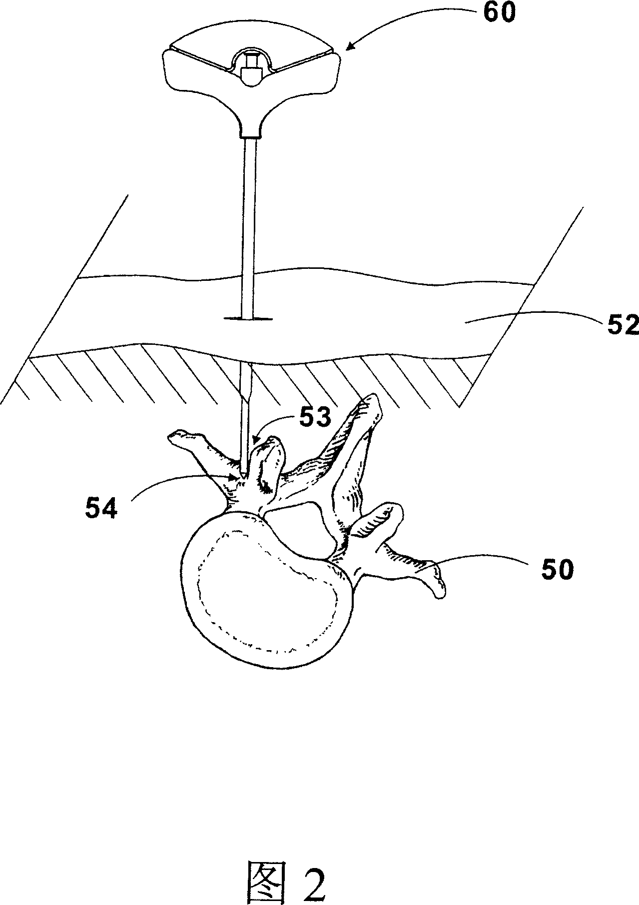 Transdermal guiding bone reaming tool device and method