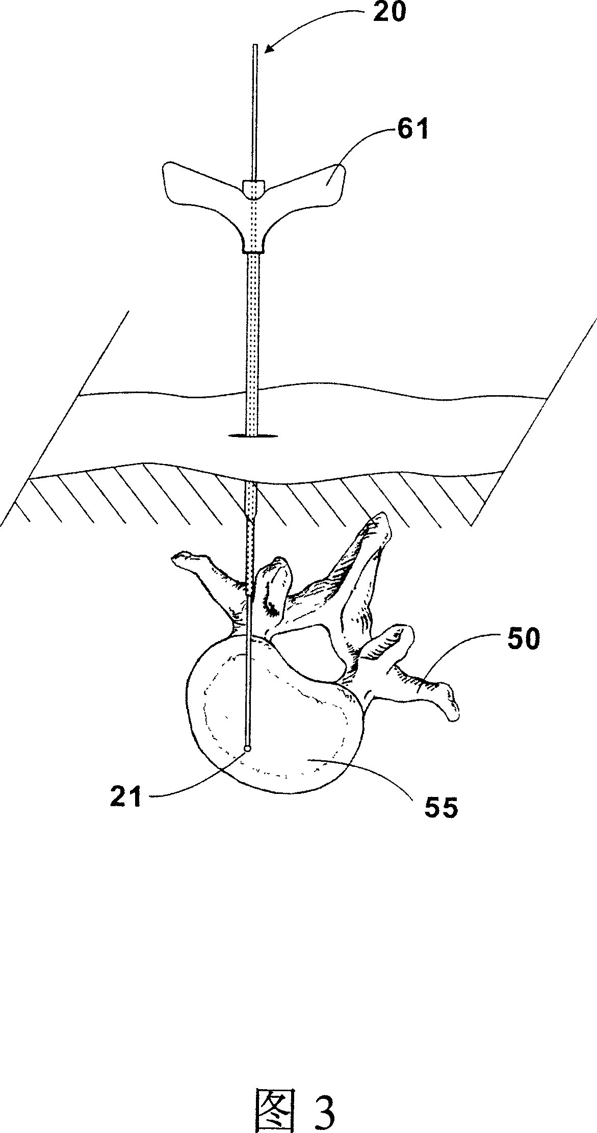 Transdermal guiding bone reaming tool device and method