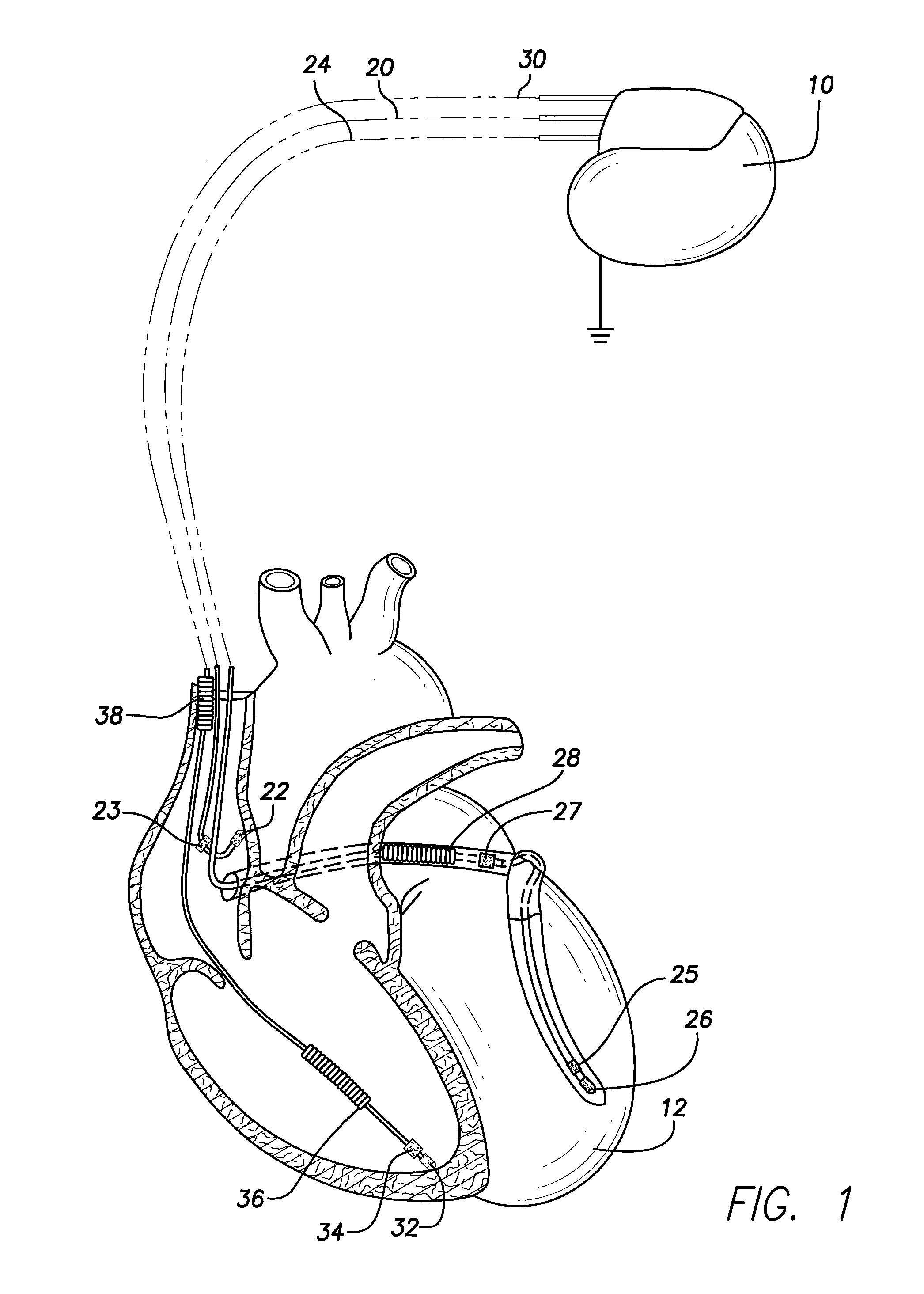 Implantable Medical Lead Circuitry and Methods for Reducing Heating and/or Induced Current