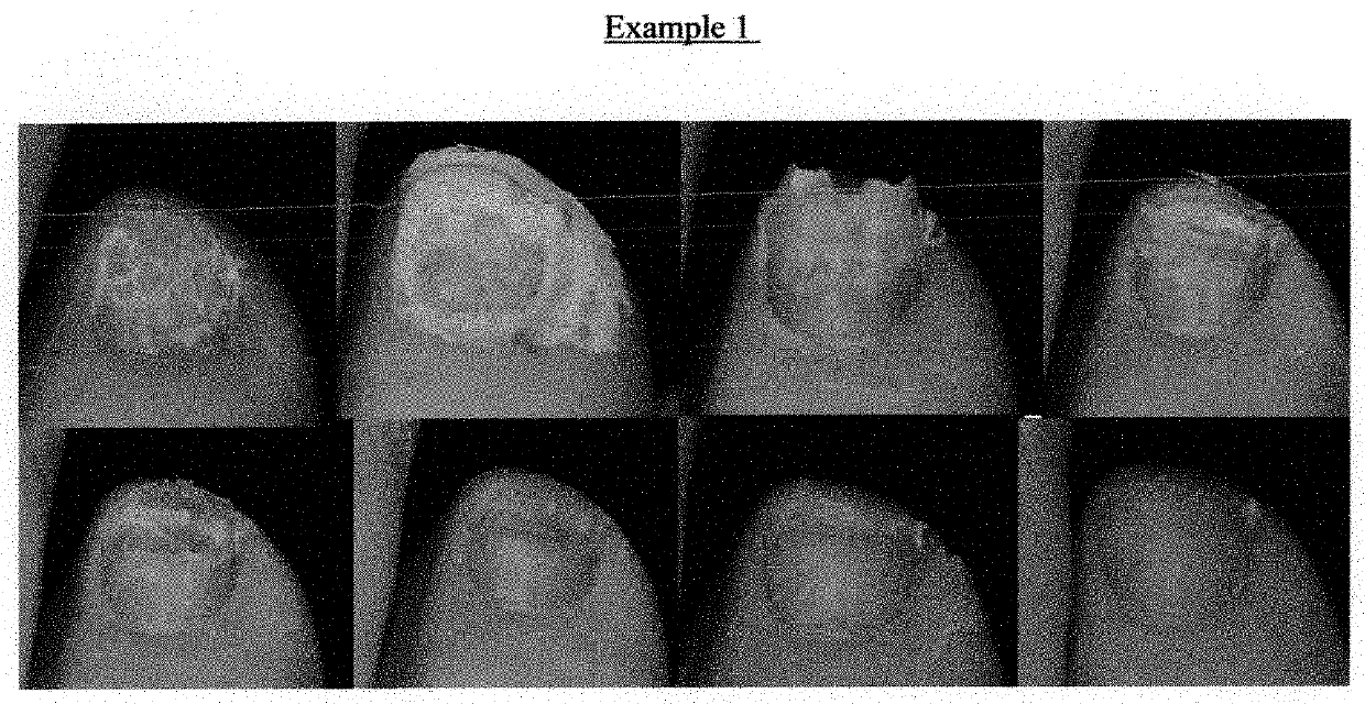 Treatment Methods and Processes for an Infected Nail