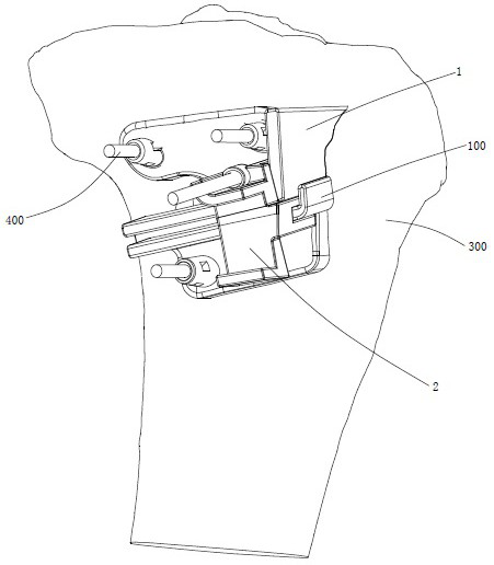 Orthopedic tibial osteotomy guide