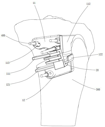 Orthopedic tibial osteotomy guide