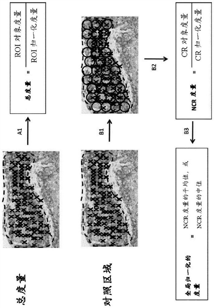 Methods and systems for evaluation of immune cell infiltrate in stage iv colorectal cancer