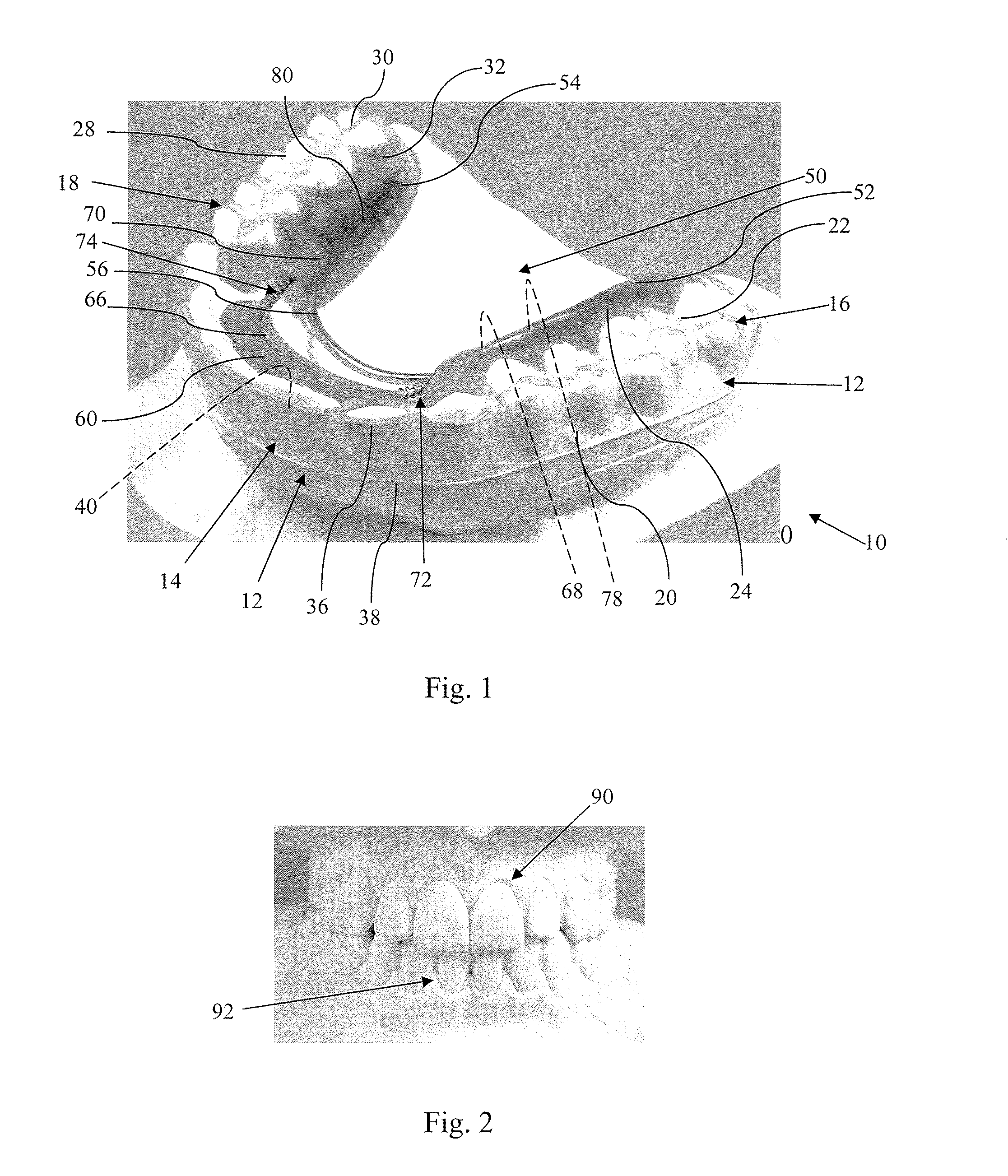 Invisible spring aligner