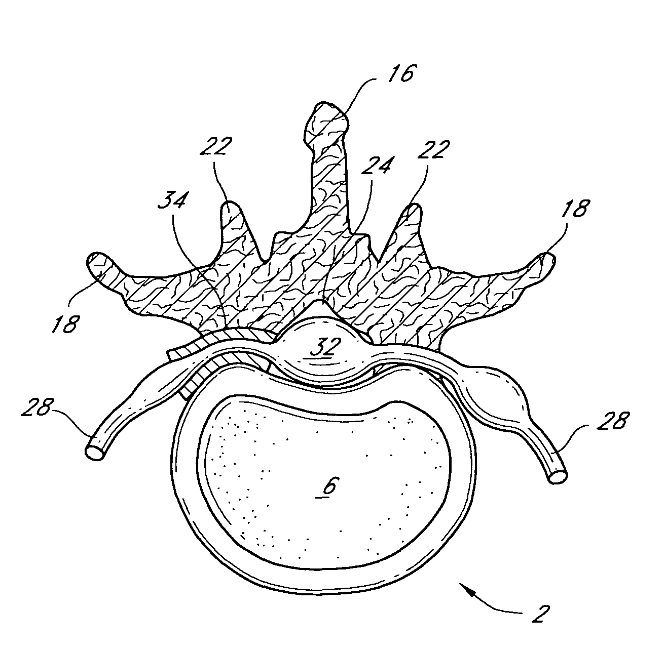 System and method for protecting neurovascular structures