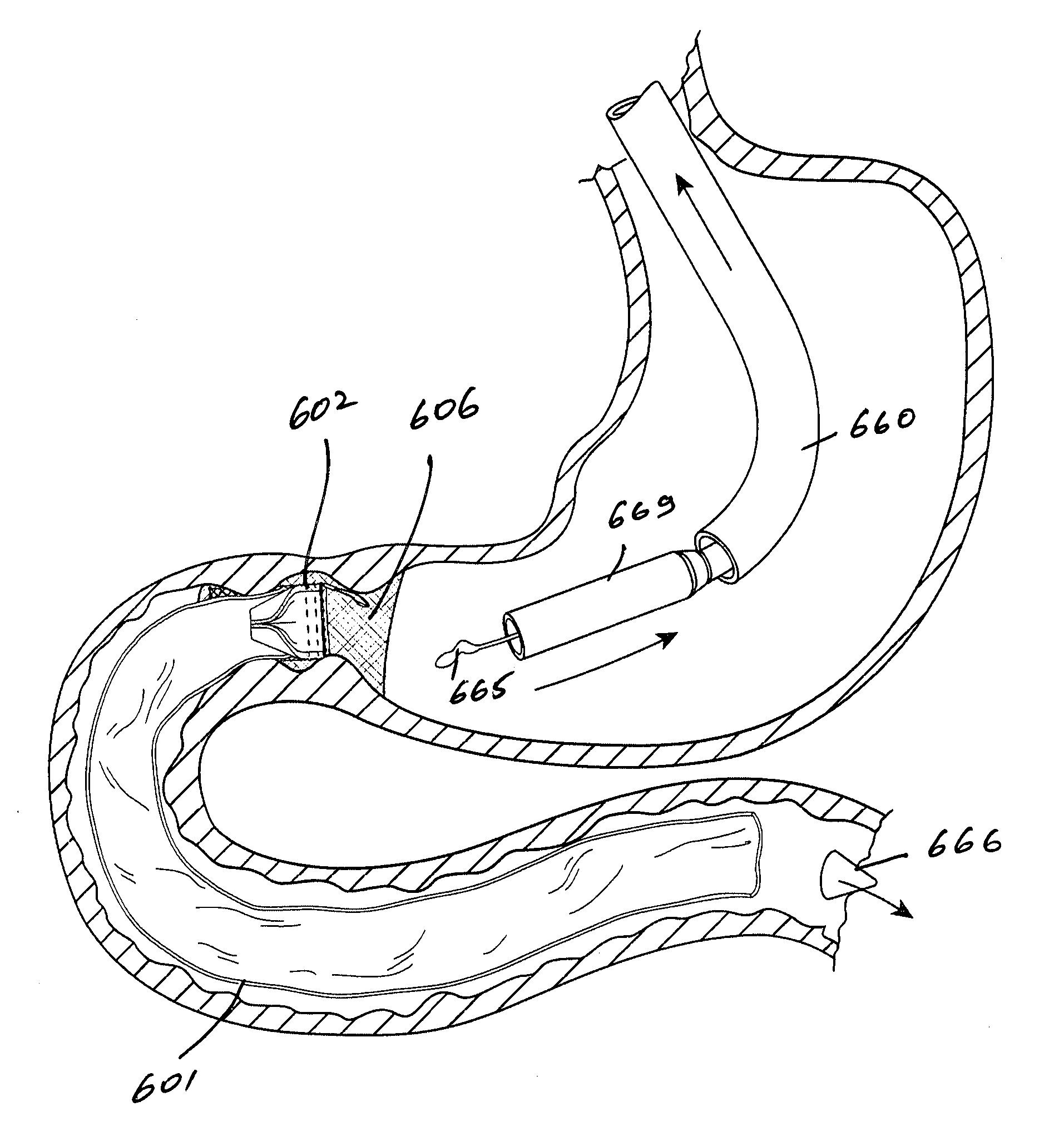 Gastrointestinal implant device