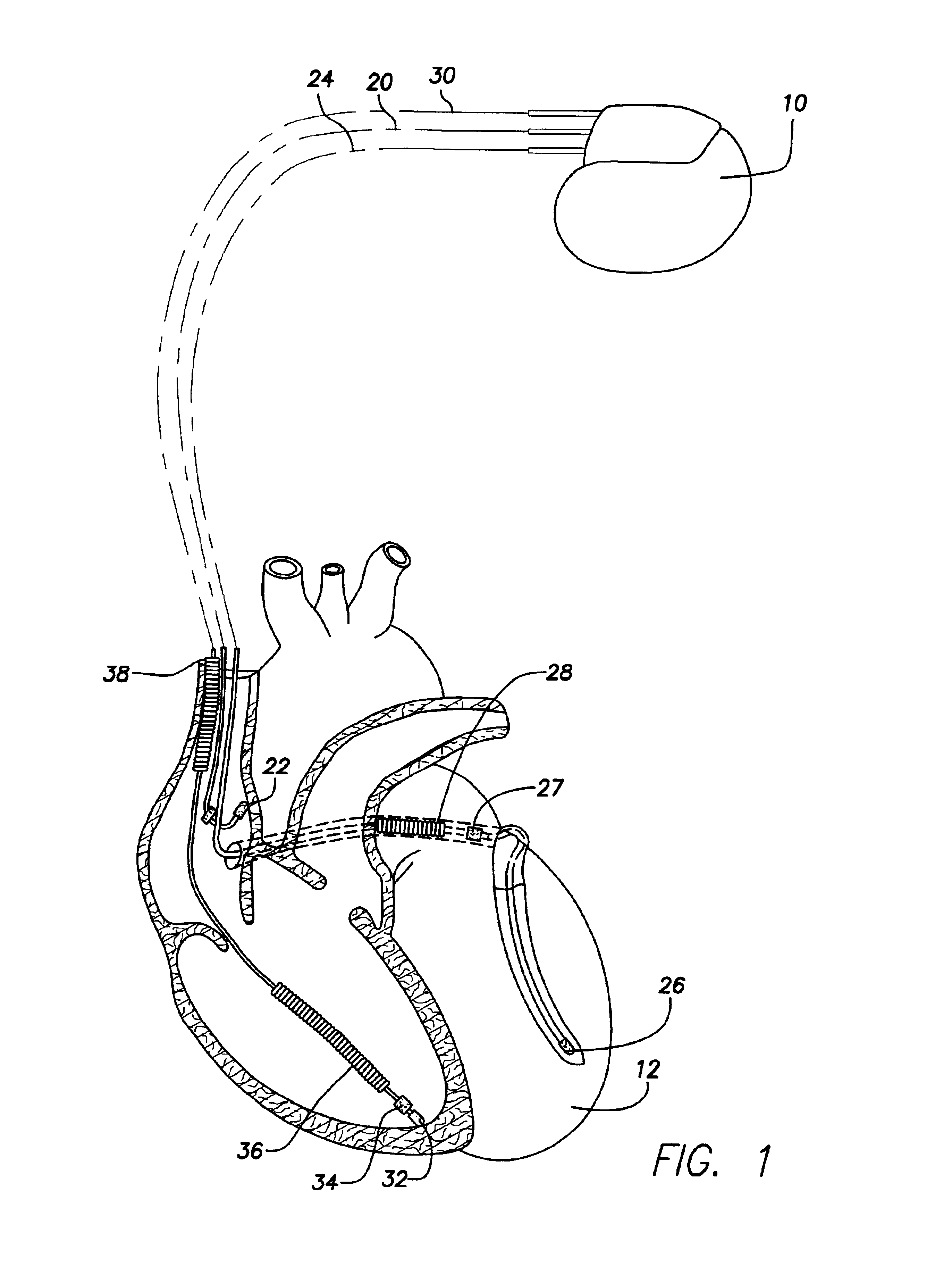 System and method for evaluating risk of mortality due to congestive heart failure using physiologic sensors