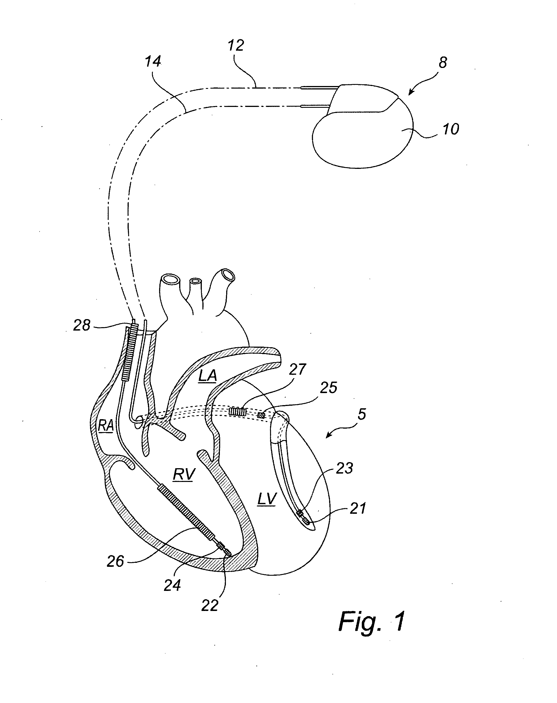 Devices and method for determining and monitoring a cardiac status of a patient by using plvdt or plvst parameters