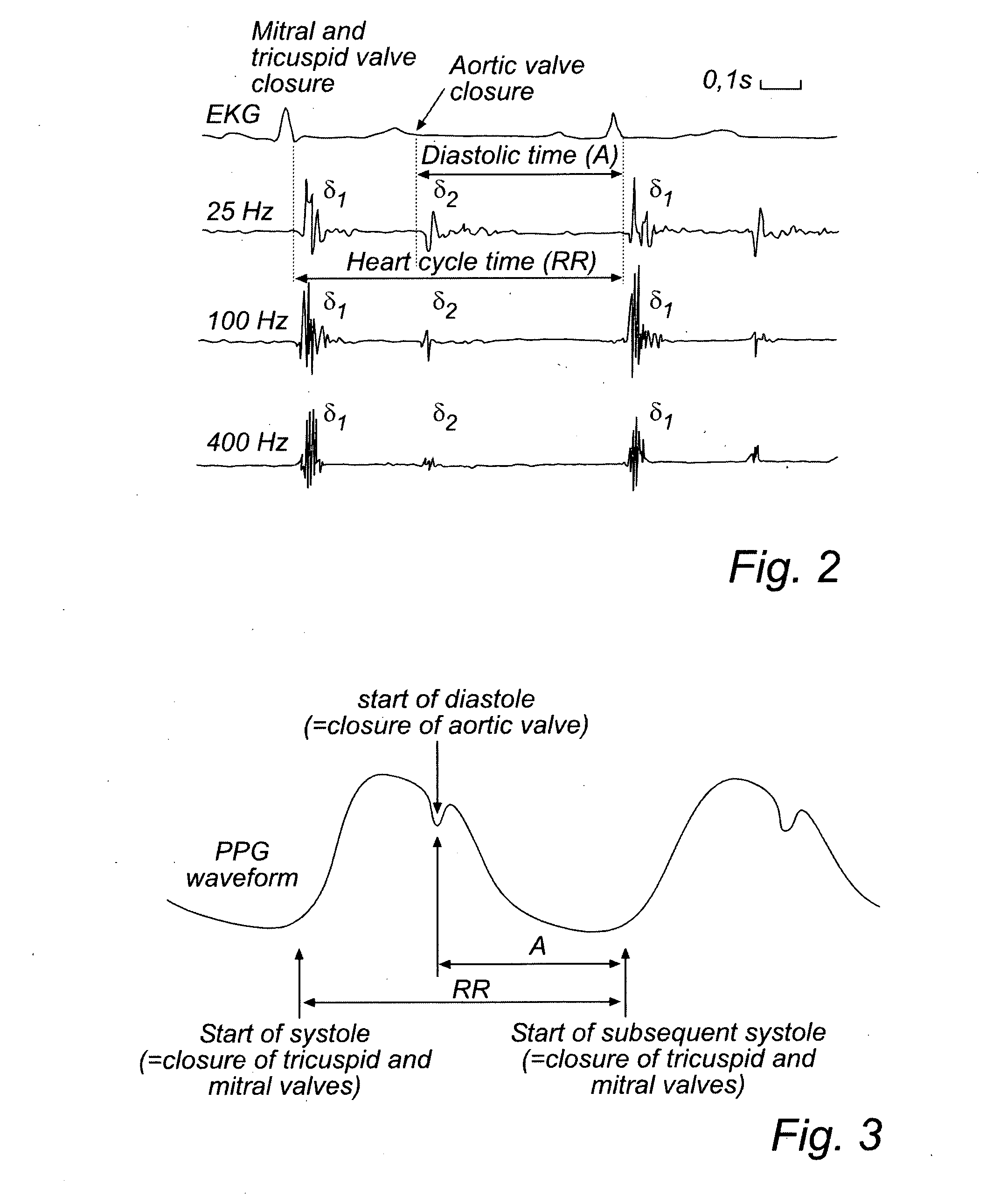 Devices and method for determining and monitoring a cardiac status of a patient by using plvdt or plvst parameters