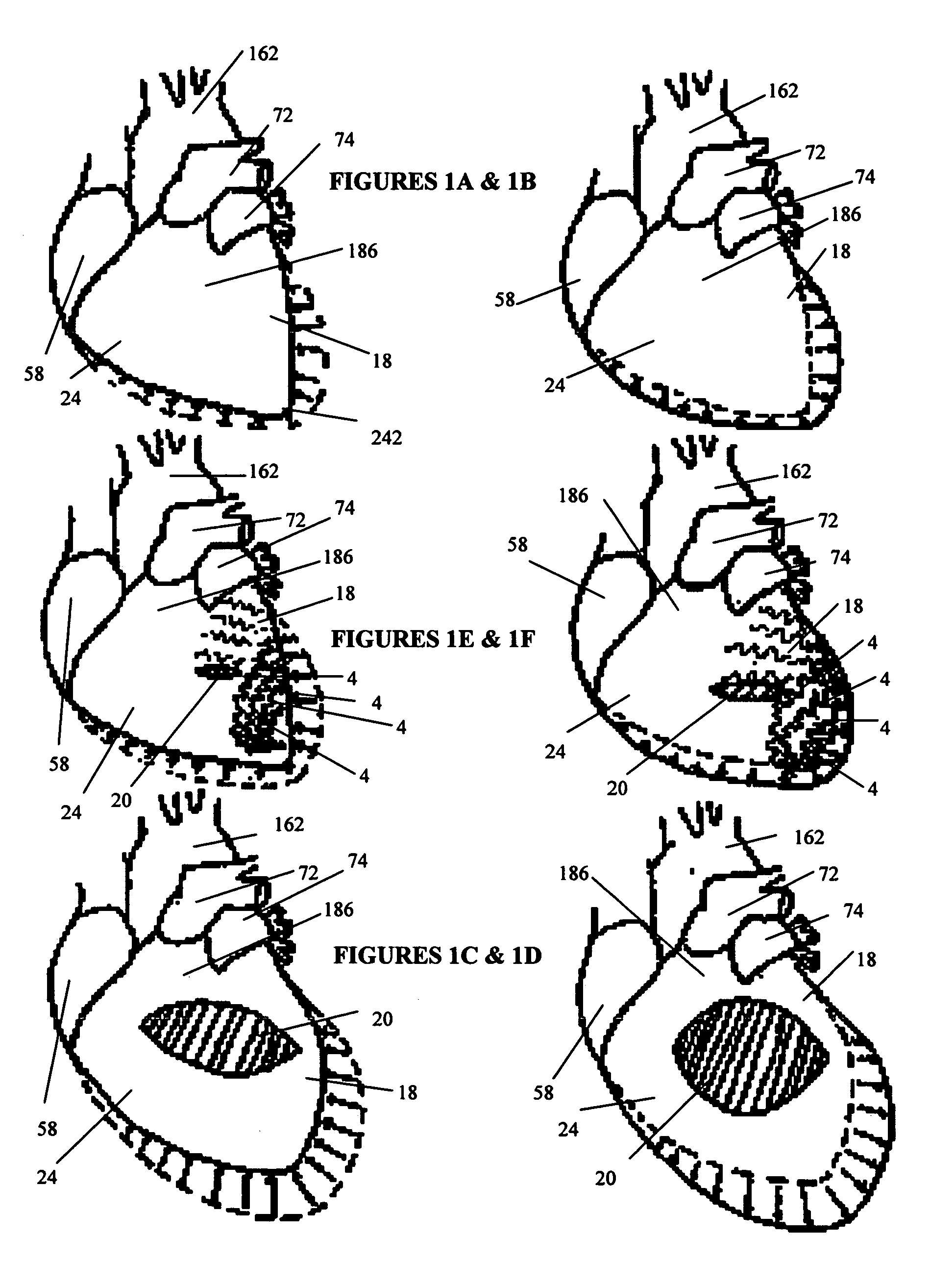 Systems for heart treatment