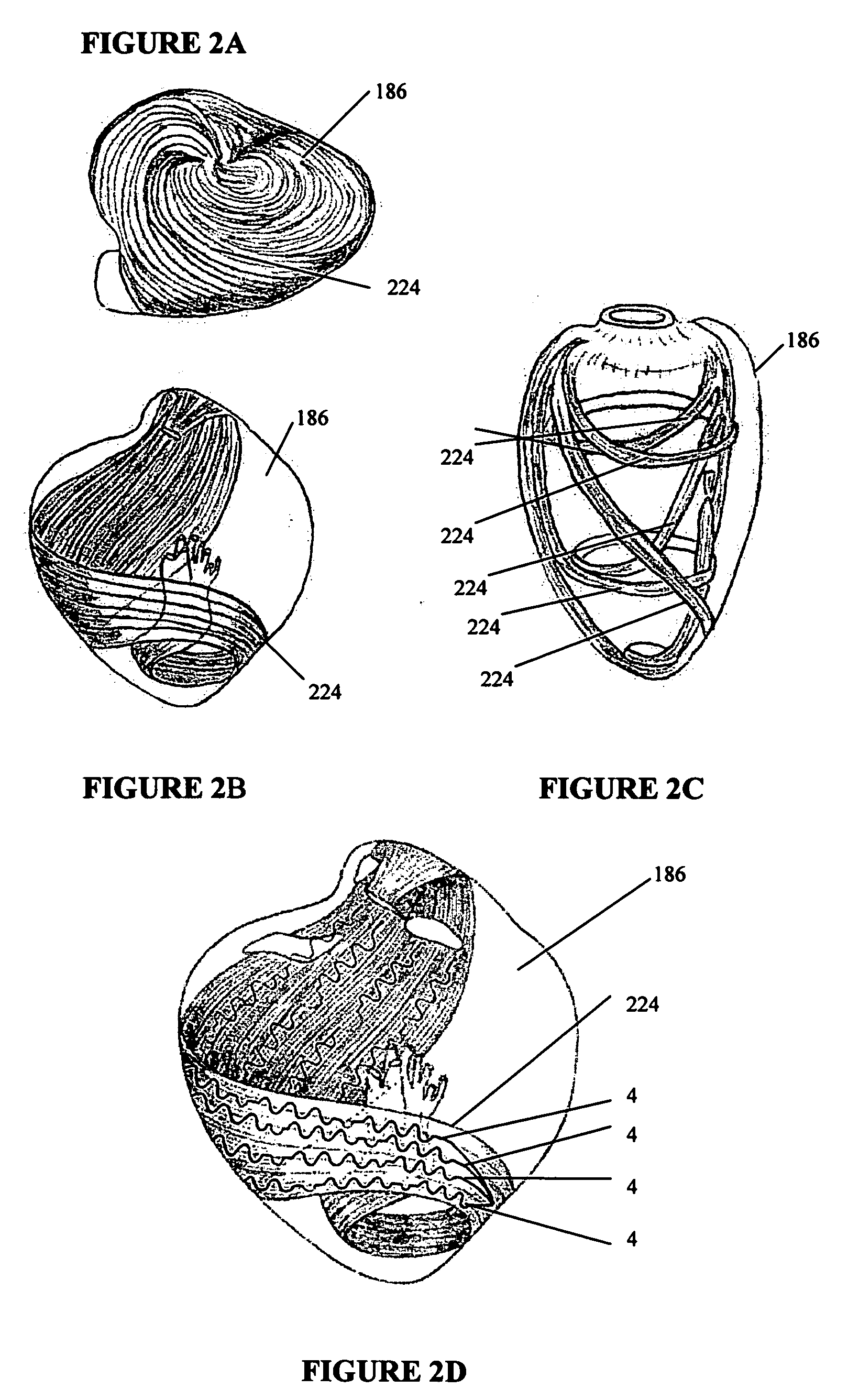 Systems for heart treatment