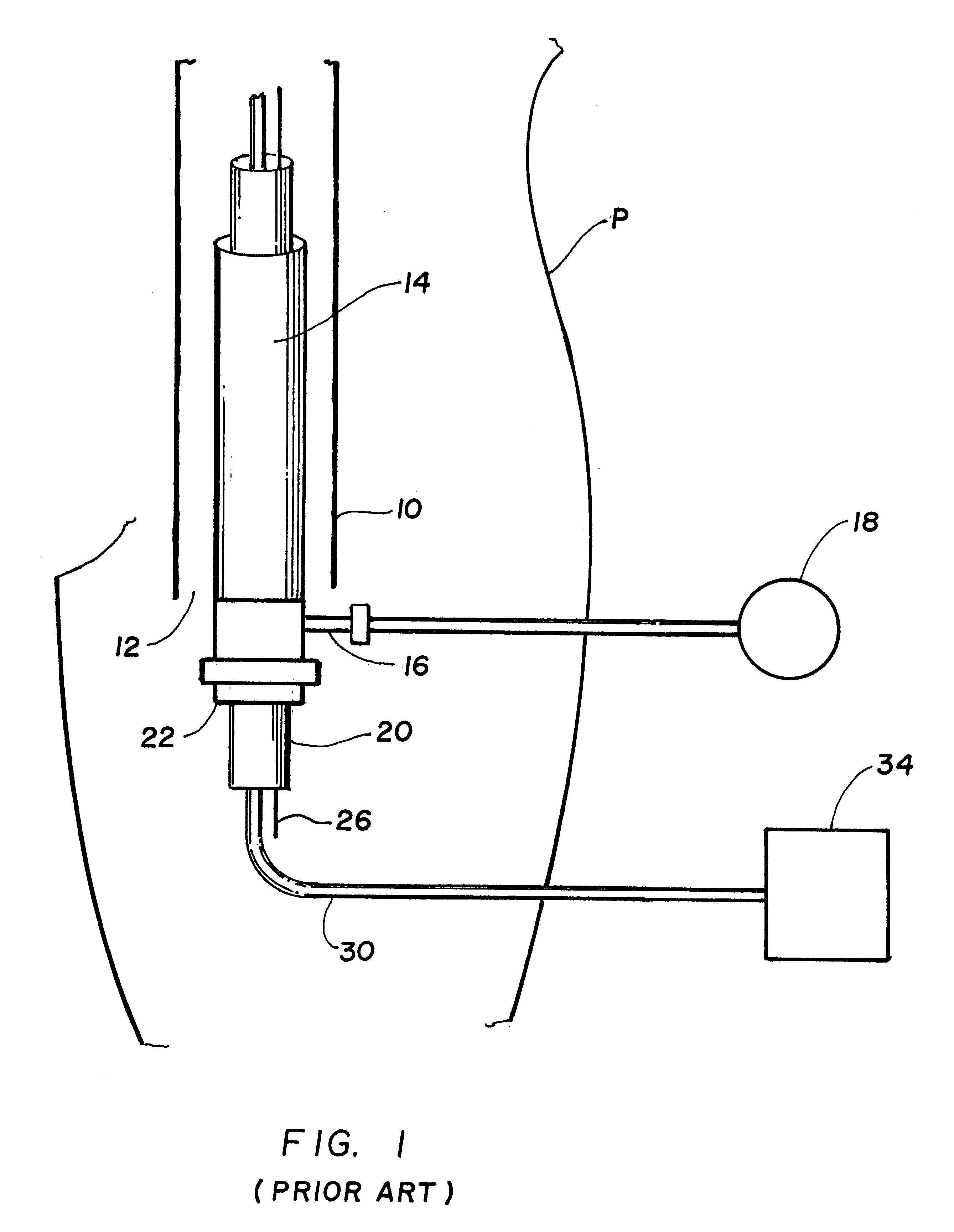 Perfusion procedure and apparatus for preventing necrosis following failed balloon angioplasty