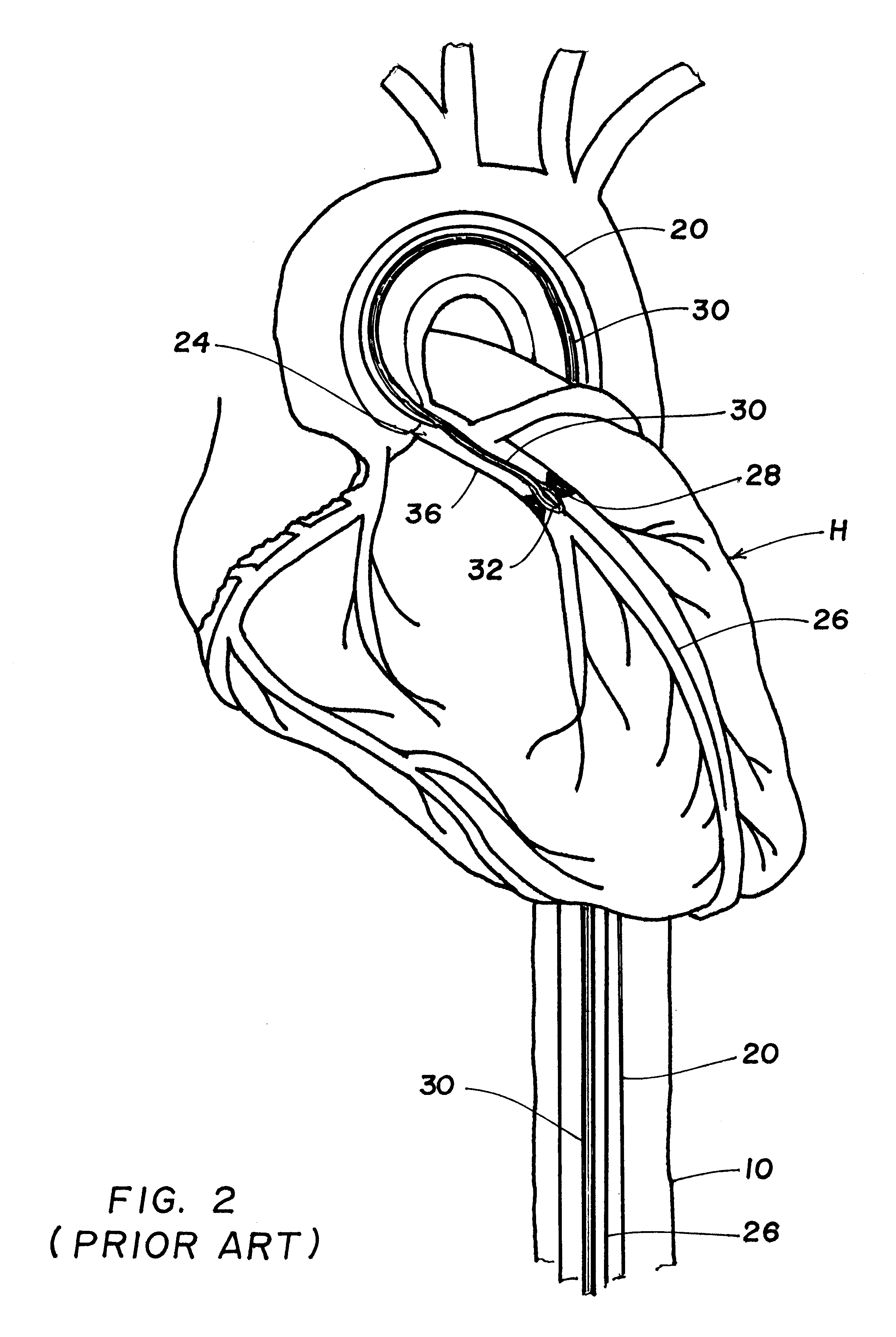 Perfusion procedure and apparatus for preventing necrosis following failed balloon angioplasty